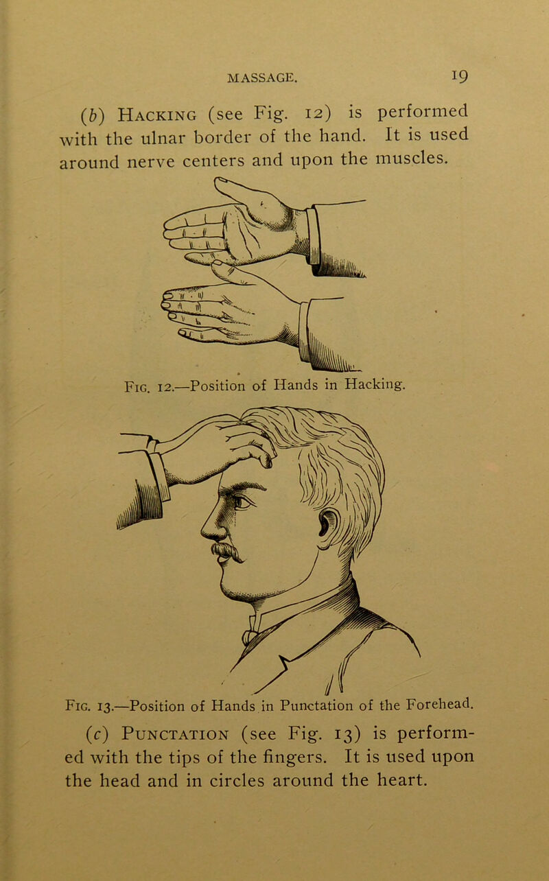 (b) Hacking (see Fig. 12) is performed with the ulnar border of the hand. It is used around nerve centers and upon the muscles. Fig. 13.—Position of Hands in Punctation of the Forehead. (c) Punctation (see Fig. 13) is perform- ed with the tips of the fingers. It is used upon the head and in circles around the heart.