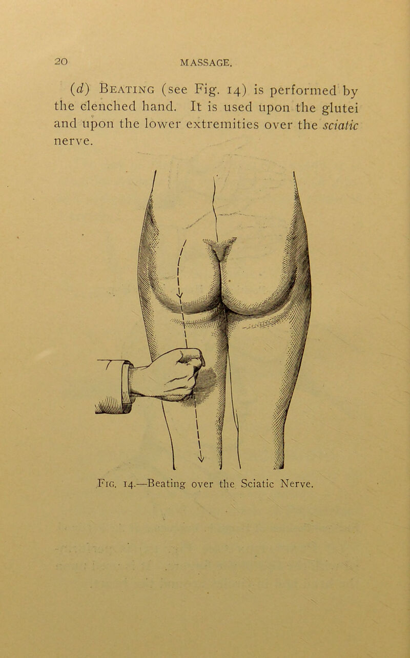 Fig. 14.—Beating over the Sciatic Nerve. (d) Beating (see Fig. 14) is performed by the clenched hand. It is used upon the glutei tf and upon the lower extremities over the sciatic nerve.