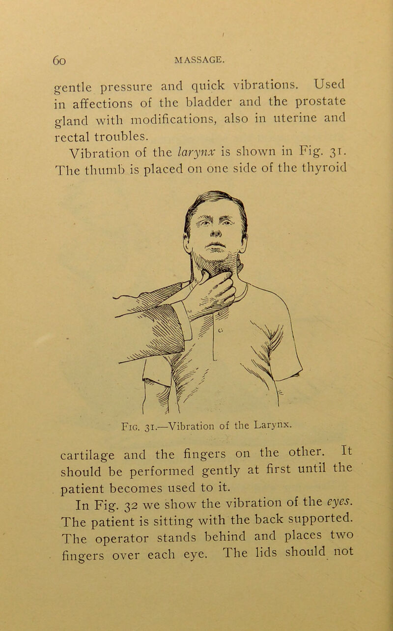 bo. / entle pressure and quick vibrations. Used m affections of the bladder and the prostate gland with modifications, also in uterine and rectal troubles. Vibration of the larynx is shown in Fig. 31. The thumb is placed on one side of the thyroid cartilage and the fingers on the othei. It should be performed gently at first until the patient becomes used to it. In Fig. 32 we show the vibration of the eyes. The patient is sitting with the back supported. The operator stands behind and places two fingers over each eye. The lids should not Fig. 31.—Vibration of the Larynx.