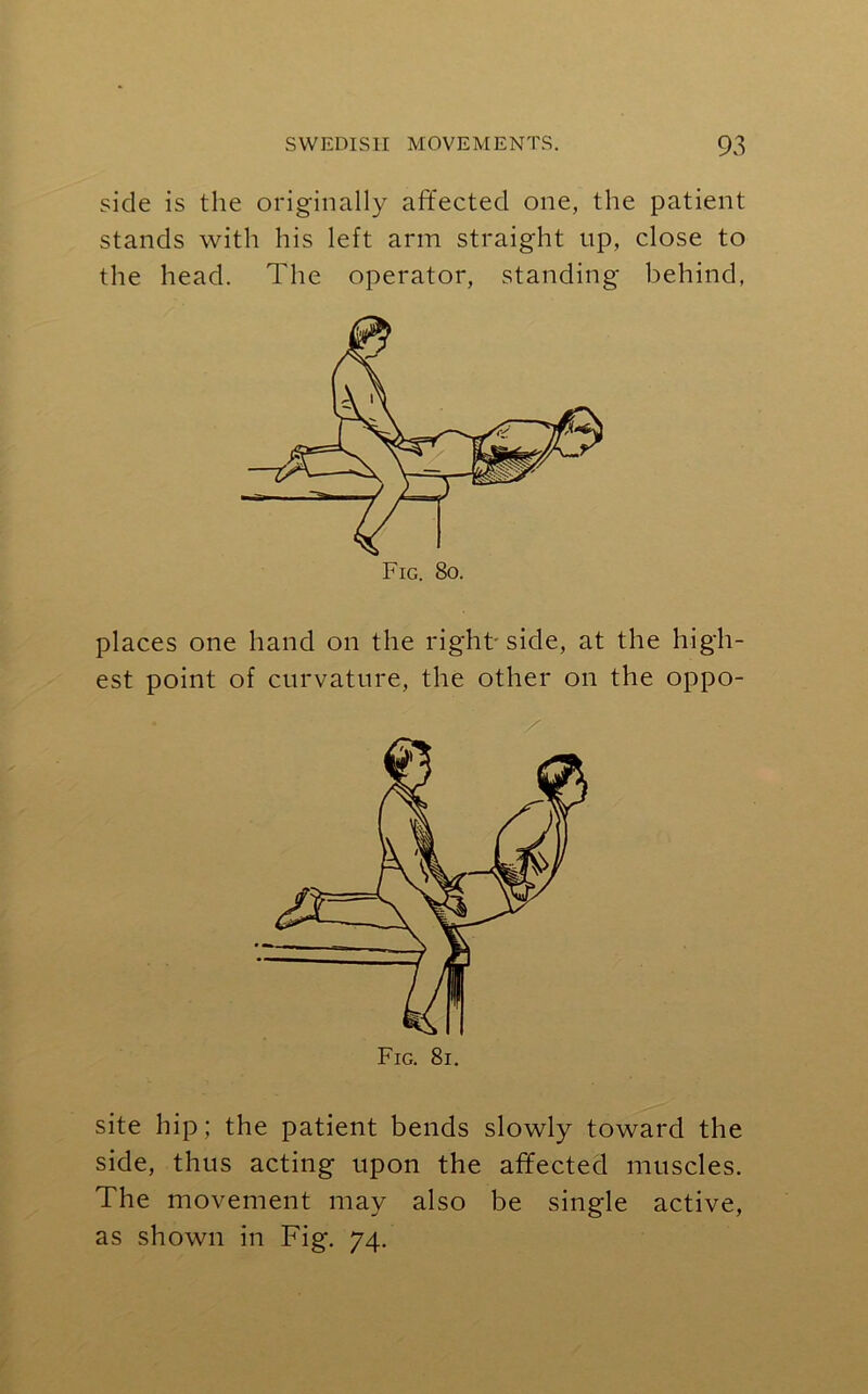 side is the originally affected one, the patient stands with his left arm straight up, close to the head. The operator, standing behind, Fig. 8o. places one hand on the right'side, at the high- est point of curvature, the other on the oppo- site hip; the patient bends slowly toward the side, thus acting upon the affected muscles. The movement may also be single active, as shown in Fig. 74.