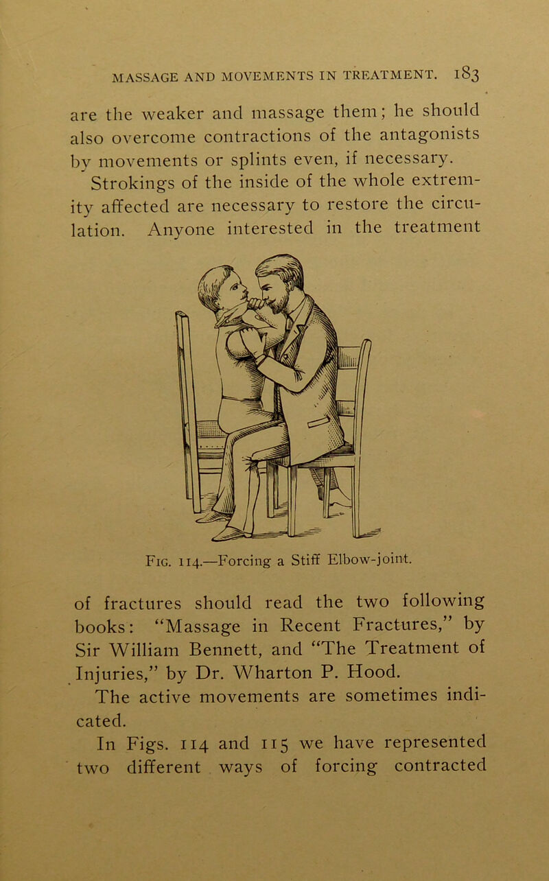 are the weaker and massage them; he should also overcome contractions of the antagonists by movements or splints even, if necessary. * Strokings of the inside of the whole extrem- ity affected are necessary to restore the circu- lation. Anyone interested in the treatment Fig. 114.—Forcing a Stiff Elbow-joint. of fractures should read the two following books: “Massage in Recent Fractures,” by Sir William Bennett, and “The Treatment of Injuries,” by Dr. Wharton P. Hood. The active movements are sometimes indi- cated. In Figs. 114 and 115 we have represented two different ways of forcing contracted