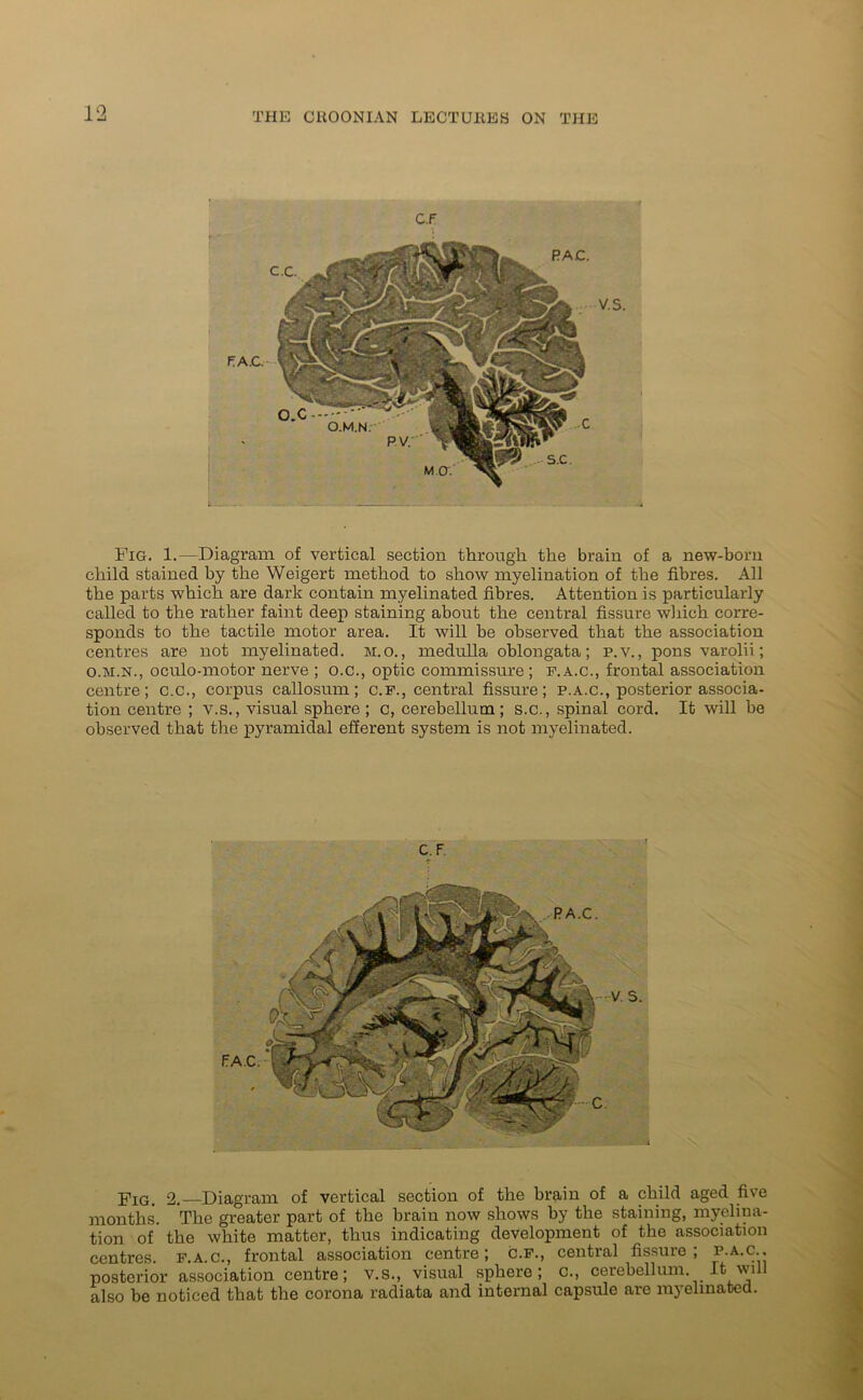 Fig. 1.—Diagram of vertical section through the brain of a new-born child stained by the Weigert method to show myelination of the fibres. All the parts which are dark contain myelinated fibres. Attention is particularly called to the rather faint deep staining about the central fissure which corre- sponds to the tactile motor area. It will be observed that the association centres are not myelinated, m.o. , medulla oblongata; p.v., pons varolii; o.m.h., oculo-motor nerve ; o.c., optic commissure; f.a.c., frontal association centre; c.c., corpus callosum; c.f., central fissure; p.a.c., posterior associa- tion centre ; v.s., visual sphere; c, cerebellum; s.c., spinal cord. It will be observed that the pyramidal efferent system is not myelinated. jnIG> 2. Diagram of vertical section of the brain of a child aged five months. The greater part of the brain now shows by the staining, myelina- tion of the white matter, thus indicating development of the association centres, f.a.c., frontal association centre; c.f., central fissure; p.a.c.. posterior association centre; v.s., visual sphero; c., cerebellum. It will also be noticed that the corona radiata and internal capsule are myelinated.