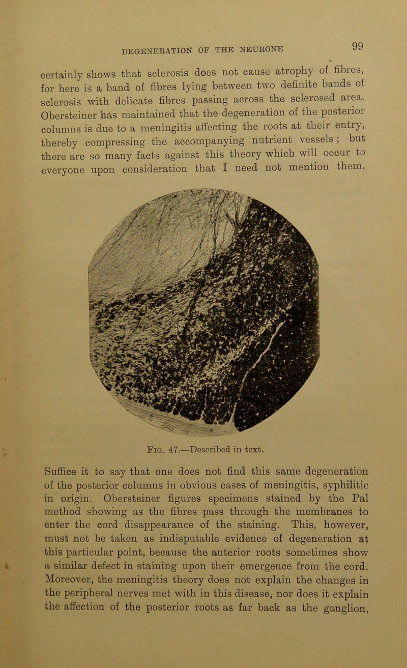 certainly shows that sclerosis does not cause atrophy of fibres, for here is a band of fibres lying between two definite bands of sclerosis with delicate fibres passing across the sclerosed area. Obersteiner has maintained that the degeneration of the posteiioi columns is due to a meningitis affecting the roots at their entry, thereby compressing the accompanying nutrient vessels; but there are so many facts against this theory which will occur to everyone upon consideration that I need not mention them. Fig. 47.—Described in text. Suffice it to say that one does not find this same degeneration of the posterior columns in obvious cases of meningitis, syphilitic in origin. Obersteiner figures specimens stained by the Pal method showing as the fibres pass through the membranes to enter the cord disappearance of the staining. This, however, must not be taken as indisputable evidence of degeneration at this particular point, because the anterior roots sometimes show a similar defect in staining upon their emergence from the cord. Moreover, the meningitis theory does not explain the changes in the peripheral nerves met with in this disease, nor does it explain the affection of the posterior roots as far back as the ganglion,