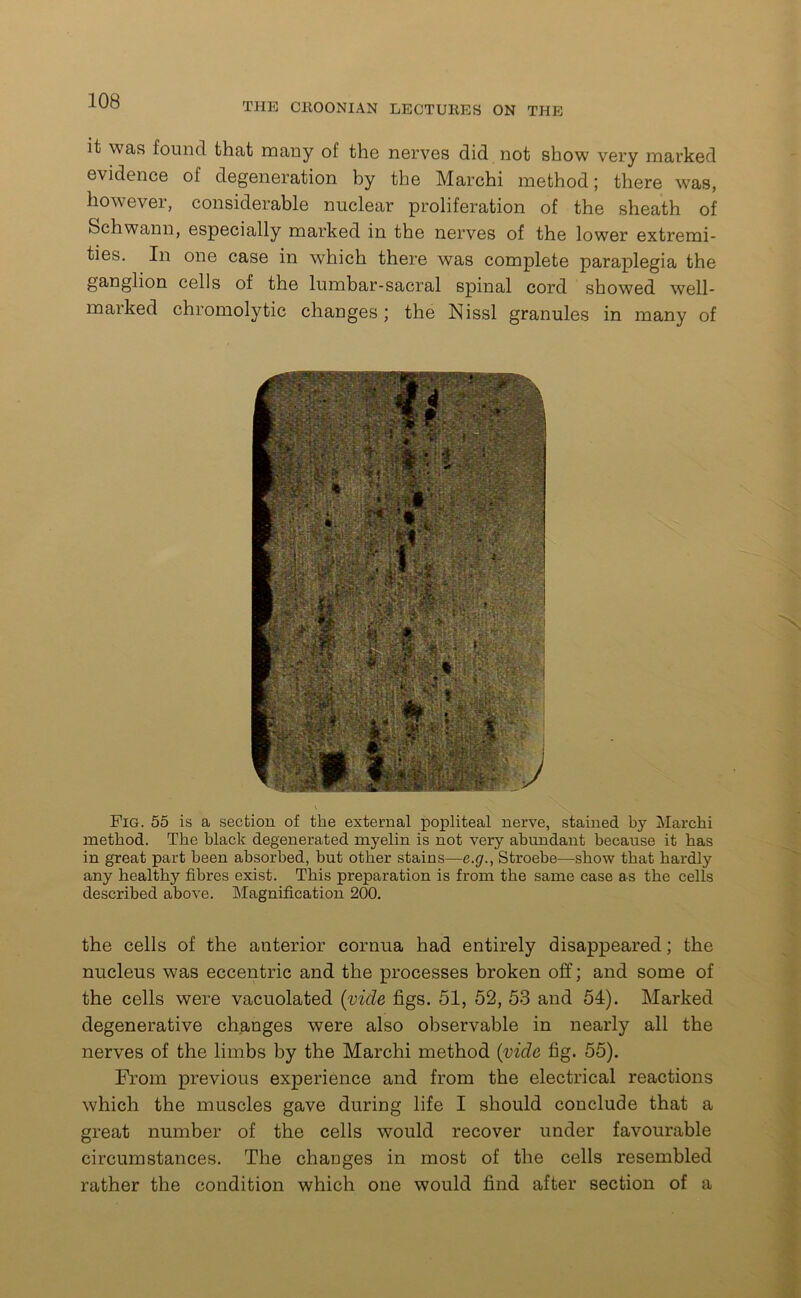 THE CEOONIAN LECTUliES ON THE it was found that many of the nerves did not show very marked evidence of degeneration by the Marchi method; there was, however, considerable nuclear proliferation of the sheath of Schwann, especially marked in the nerves of the lower extremi- ties. In one case in which there was complete paraplegia the ganglion cells of the lumbar-sacral spinal cord showed well- marked chromolytic changes; the Nissl granules in many of Fig. 55 is a section of the external popliteal nerve, stained by Marchi method. The black degenerated myelin is not very abundant because it has in great part been absorbed, but other stains—e.g., Stroebe—show that hardly any healthy fibres exist. This preparation is from the same case as the cells described above. Magnification 200. the cells of the anterior cornua had entirely disappeared; the nucleus was eccentric and the processes broken off; and some of the cells were vacuolated (vide figs. 51, 52, 53 and 54). Marked degenerative changes were also observable in nearly all the nerves of the limbs by the Marchi method (vide fig. 55). From previous experience and from the electrical reactions which the muscles gave during life I should conclude that a great number of the cells would recover under favourable circumstances. The changes in most of the cells resembled rather the condition which one would find after section of a