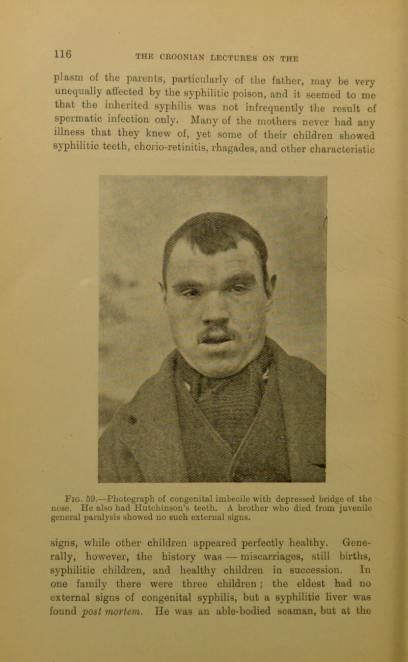 plasm of the parents, particularly of the father, may be very unequal!} affected by the syphilitic poison, and it seemed to me that the inherited syphilis was not infrequently the result of spermatic infection only. Many of the mothers never had any illness that they knew of, yet some of their children showed syphilitic teeth, chorio-retinitis, rhagades, and other characteristic Fig. 59.—Photograph of congenital imbecile with depressed bridge of the nose. He also had Hutchinson’s teeth. A brother who died from juvenile general paralysis showed no such external signs. signs, while other children appeared perfectly healthy. Gene- rally, however, the history was — miscarriages, still births, syphilitic children, and healthy children iu succession. In one family there were three children ; the eldest had no external signs of congenital syphilis, but a syphilitic liver was found post mortem. He was an able-bodied seaman, but at the