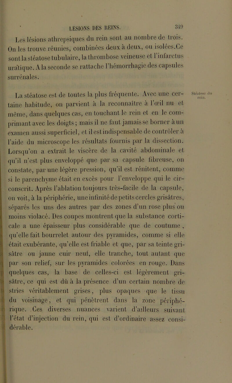 Les lésions athrepsiques du rein sont au nombre de trois. On les trouve réunies, combinées deux a deux, ou isolées.Ce sont la stéatose tubulaire, la thrombose veineuse et l’infarctus uratique. A la seconde se rattache l’hémorrhagie des capsules surrénales. La stéatose est de toutes la plus fréquente. Avec une cer- taine habitude, on parvient à la reconnaître à l’œil nu et même, dans quelques cas, en touchant le rein et en le com- primant avec les doigts ; mais il ne faut jamais se borner à un examen aussi superficiel, et il est indispensable de contrôler a l’aide du microscope les résultats fournis par la dissection. Lorsqu’on a extrait le viscère de la cavité abdominale eL qu’il n’est plus enveloppé que par sa capsule fibreuse, on constate, par une légère pression, qu’il est rénitent, comme si le parenchyme était en excès pour l’enveloppe qui le cir- conscrit. Après l’ablation tou jours très-facile de la capsule, on voit, à la périphérie, une infinité de petits cercles grisâtres, séparés les uns des autres par des zones d’un rose plus ou moins violacé. Des coupes montrent que la substance corti- cale a une épaisseur plus considérable que de coutume , qu’elle fait bourrelet autour des pyramides, comme si elle était exubérante, qu’elle est friable et que, par sa teinte gri- sâtre ou jaune cuir neuf, elle tranche, tout autant que par son relief, sur les pyramides colorées en rouge. Dans I quelques cas, la base de celles-ci est légèrement gri- sâtre, ce qui est du à la présence d’un certain nombre de stries véritablement grises, plus opaques que le tissu du voisinage, et qui pénètrent dans la zone périphé- rique. Ces diverses nuances varient d’ailleurs suivant l’état d’injection du rein, qui est d’ordinaire assez consi- dérable. Stdatose dis rein.