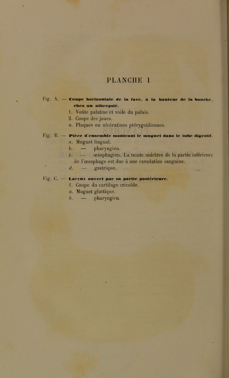 g. A. — Coupc horizontale de lu race, à lu hauteur de la bouche, chez un athrcpsic. 1. Voûte palatine et voile du palais. 2. Coupe des joues. a. Plaques ou ulcérations ptérygoïdiennes. g. IL — Pièce d'ensemble montrant le muguet dans le tube digcstir. a. Muguet lingual. b. — pharyngien. c. — œsophagien. La teinte noirâtre de la partie inférieure de l’œsophage est due à une exsudation sanguine. d. — gastrique. g. C. — l.arynx ouvert par sa purtic postérieure. 1. Coupe du cartilage cricoïde. a. Muguet glottique. I). — pharyngien.
