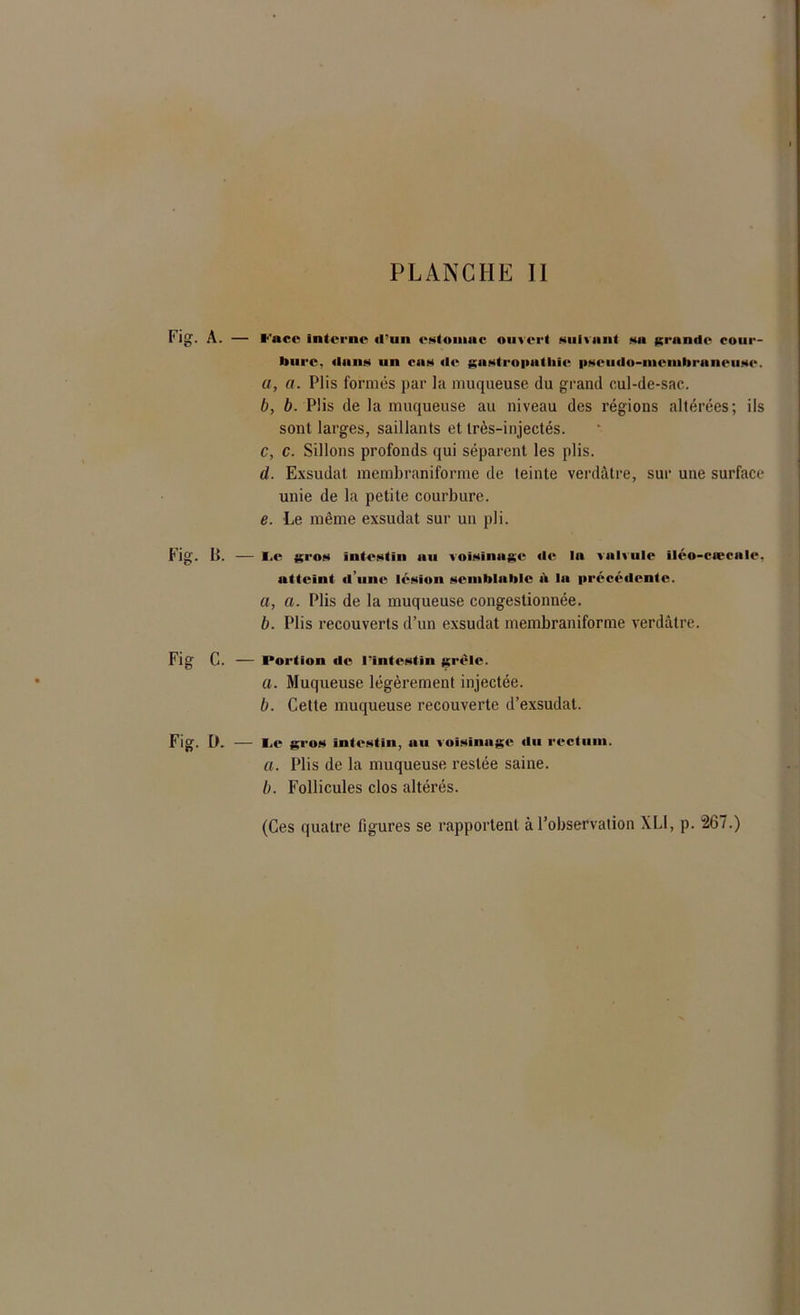 l'Ig. A. — l'nec intcrnr (l’un rxlonmc ouvert suivant mu grande cour- bure. dmiM un cum «le gastropathie pseudo-membraneuse. a, a. Plis formés par la muqueuse du grand cul-de-sac. b, b. Plis de la muqueuse au niveau des régions altérées; ils sont larges, saillants et très-injectés. C, c. Sillons profonds qui séparent les plis. d. Exsudât membraniforme de teinte verdâtre, sur une surface unie de la petite courbure. e. Le même exsudât sur un pli. Fig. B. — I.c gros intestin au voisinage «le la valvule il«*o-caecale, atteint «l’une lésion semblable à la précédente. a, a. Plis de la muqueuse congestionnée. b. Plis recouverts d’un exsudât membraniforme verdâtre. Fig C. — I*ortion «le l'intestin grêle. a. Muqueuse légèrement injectée. b. Cette muqueuse recouverte d’exsudat. Fig. [t. — l.e gros intestin, au voisinage «lu rectum. a. Plis de la muqueuse restée saine. b. Follicules clos altérés. (Ces quatre figures se rapportent à l’observation XLI, p. 267.)