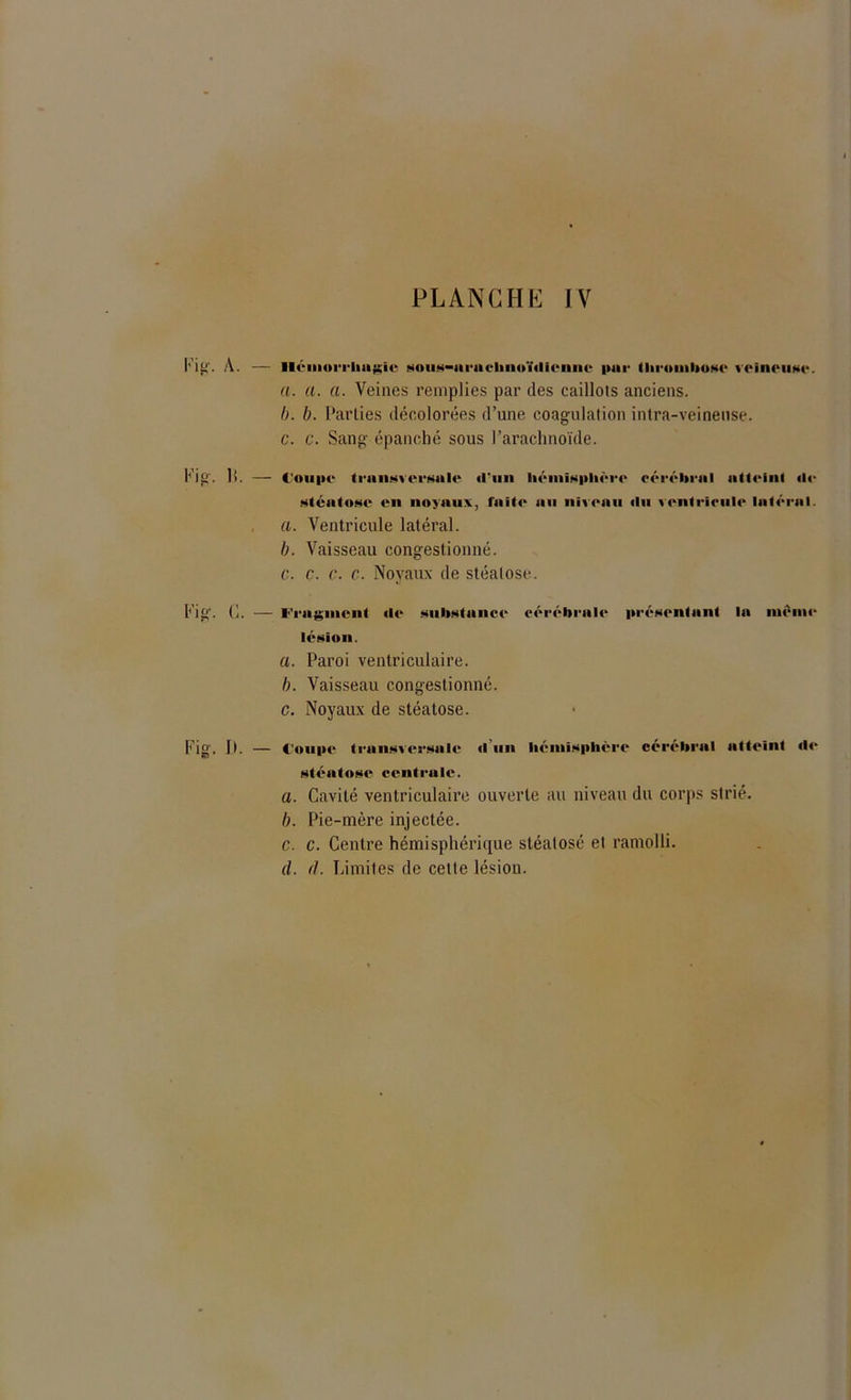Fig'. A. — Hémoi'i'luiiüie sous—ai‘acliiioï<lirmie par lluonilxtsc veineuse. a. a. a. Veines remplies par des caillots anciens. b. b. Parties décolorées d’une coagulation intra-veineuse. c. c. Sang épanché sous l’arachnoïde. Fig. li. — Coupe transversale «l'un hémisphère cérébral nltciill «le slcalost' en noyaux, faite au niveau «lu ventricule latéral. a. Ventricule latéral. b. Vaisseau congestionné. c. c. c. c. Noyaux de stéatose. Fig. C. — l‘'raginent «le substance cérébrale pr«‘scntant la même lésion. a. Paroi ventriculaire. b. Vaisseau congestionné. c. Noyaux de stéatose. Fig. II. — Coupe transversale «I un hémisphère cérébral atteint «!«• stéatose centrale. a. Cavité ventriculaire ouverte au niveau du corps strié. b. Pie-mère injectée. c. c. Centre hémisphérique stéalosé et ramolli.