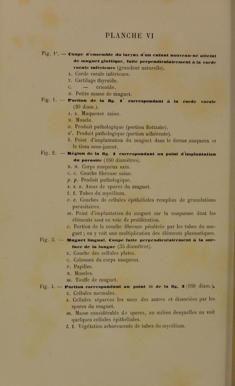 Kig. 1'. — Coupe d'ensemble du larynx d’un curant nouveau-né atteint de muguet clôt tique, faite perpendiculairement à la corde vocale inférieure (grandeur naturelle). A. Corde vocale inférieure. T. Cartilage thyroïde. c. — cricoïde. a. Petite masse de muguet. l'ig. I. — Portion «le la llg. «' correspondant à lu corde vocale (120 diam.). A. A. Muqueuse saine. M. Muscle. a. Produit pathologique (portion flottante). a'. Produit pathologique (portion adhérente). b. Point d’implantation du muguet dans le derme muqueux et le tissu sous-jacent. fig. 2. — Région «le la llg. ■ correspondant au point d'implantation du parasite (100 diamètres). M. M. Corps muqueux sain. c. c. Couche fibreuse saine. р. p. Produit pathologique. s. s. s. Amas de spores du muguet. t. t. Tubes du mycélium. e. e. Couches de cellules épithéliales remplies de granulations parasitaires. m. Point d’implantation du muguet sur la muqueuse dont les éléments sont en voie de prolifération. с. Portion de la couche fibreuse pénétrée par les tubes du mu- guet ; on y voit une multiplication des éléments plasmatiques. Fig. 3. — .Muguet lingual. Coupe faite perpendiculairement à la sur- face «le la langue (35 diamètres). E. Couche des cellules plates. c. Colonnes du corps muqueux. p. Papilles. M. Muscles. m. Touffe de muguet. Fig. î. — Portion correspondant «»u point 111 de la llg. :* (160 diaill.). E. Cellules normales. s. Cellules séparées les unes des autres et dissociées par les spores du muguet. m. Masse considérable de spores, au milieu desquelles on voit quelques cellules épithéliales. t. t. Végétation arborescente de tubes du mycélium.
