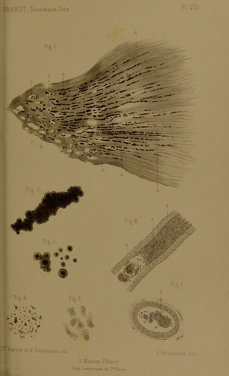 PI .VIII. PARROT, Nouveaux-Nés A JJPawot « WenaudoUeh HiUnauaol lift. G-.Masson Editeur, lmp Le-merciep et ClcPai’is
