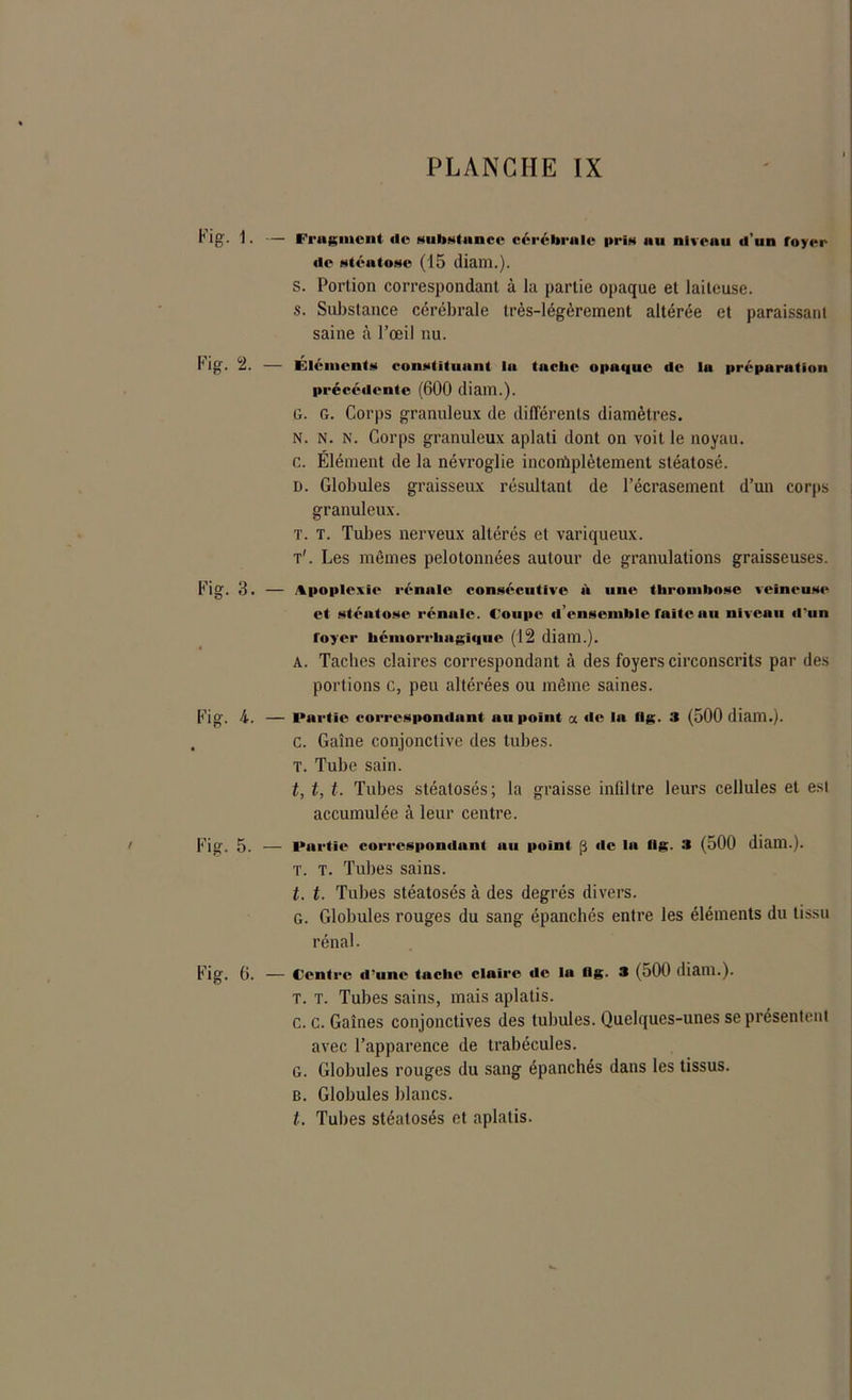 Fig. 1. — Fragment de NubNtnnce cérébrale prïH nu nlveuu d’un foyer de stéatose (15 diam.). s. Portion correspondant à la partie opaque et laiteuse. s. Substance cérébrale très-légèrement altérée et paraissant saine à l’œil nu. I‘ig. 2. — Eléments constituant lit tache opaque de la préparation précédente (600 diam.). ü. G. Corps granuleux de différents diamètres. N. N. N. Corps granuleux aplati dont on voit le noyau, c. Élément de la névroglie incortiplètement stéatosé. D. Globules graisseux résultant de l’écrasement d’un corps granuleux. T. T. Tubes nerveux altérés et variqueux. t'. Les mêmes pelotonnées autour de granulations graisseuses. Kig. ‘S. — Apoplexie rénale consécutive à une thrombose veineuse et stéutose rénale. Coupe d’ensemble faite nu niveau d'un foyer hémorrhagique (12 diam.). A. Taches claires correspondant à des foyers circonscrits par des portions c, peu altérées ou même saines. Fig. 4. — Partie correspondant nu point a de In flg. .< (500 diam.). . c. Gaine conjonctive des tubes. T. Tube sain. t, t, t. Tubes stéalosés; la graisse infiltre leurs cellules et est accumulée à leur centre. Fig. 5. — Partie correspondant au point p de in «g. a (500 diam.). T. T. Tubes sains. t. t. Tubes stéatosés à des degrés divers. G. Globules rouges du sang épanchés entre les éléments du tissu rénal. Fig. 6. — Centre d'une tache claire de la llg. a (500 diam.). T. t. Tubes sains, mais aplatis. c. c. Gaines conjonctives des tubules. Quelques-unes se présentent avec l’apparence de trabécules. G. Globules rouges du sang épanchés dans les tissus. B. Globules blancs. t. Tubes stéatosés et aplatis.