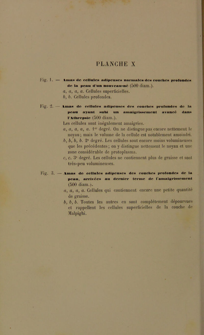l*’ig. I. — imns alu cellules aalipcuscs normales aies couches profonde* ale lit peau d'un nouveau-né (500 (liam.). a, a, a, a. Cellules superficielles. b, b. Cellules profondes. Fig. 1 — Amas ale cellules adipeuses aies caniches profondes de la peau ayant subi un nmoïgrisscnmnt avança* aluns l’Athrepsie (500 diaiïl.). Les cellules sont inégalement amaigries. a, a, a, a, a. 1er degré. On ne distingue pas encore nettement le noyau; mais le volume de la cellule est notablement amoindri. b, b, b, b. 2e degré. Les cellules sont encore moins volumineuses que les précédentes; on y distingue nettement le noyau et une zone considérable de protoplasma. c, c. 3e degré. Les cellules ne contiennent plus de graisse et sont très-peu volumineuses. Kig. 3. — Amas ale cellules aalipeuses aies couches profonales ale la peau, arrivées au alernïcr terme ale l’amaigrissement (500 diam. ). a, a, a, a. Cellules qui contiennent encore une petite quantité de graisse. b, b, b. Toutes les autres en sont complètement dépourvues et rappellent les cellules superficielles de la couche de Malpighi.