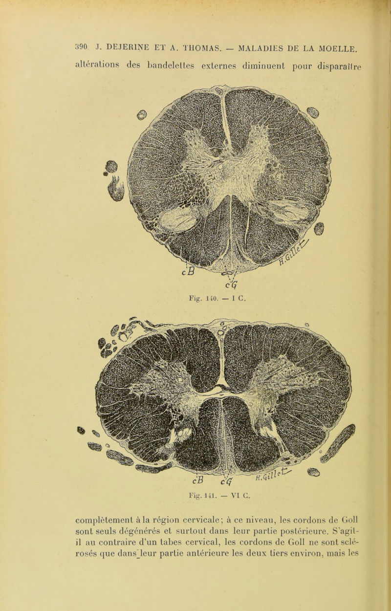 alléralions des l)andeleües externes diminuent pour disparaîire Fig. liO. — IG. Fig. 1 il. — VI G. complètement à la région cervicale; à ce niveau, les cordons de Goll sont seuls dégénérés et surtout dans leur partie postérieure. S’agit- il au contraire d’un tabes cervical, les cordons de Goll ne sont sclé- rosés que dansleur partie antérieure les deux tiers environ, mais les