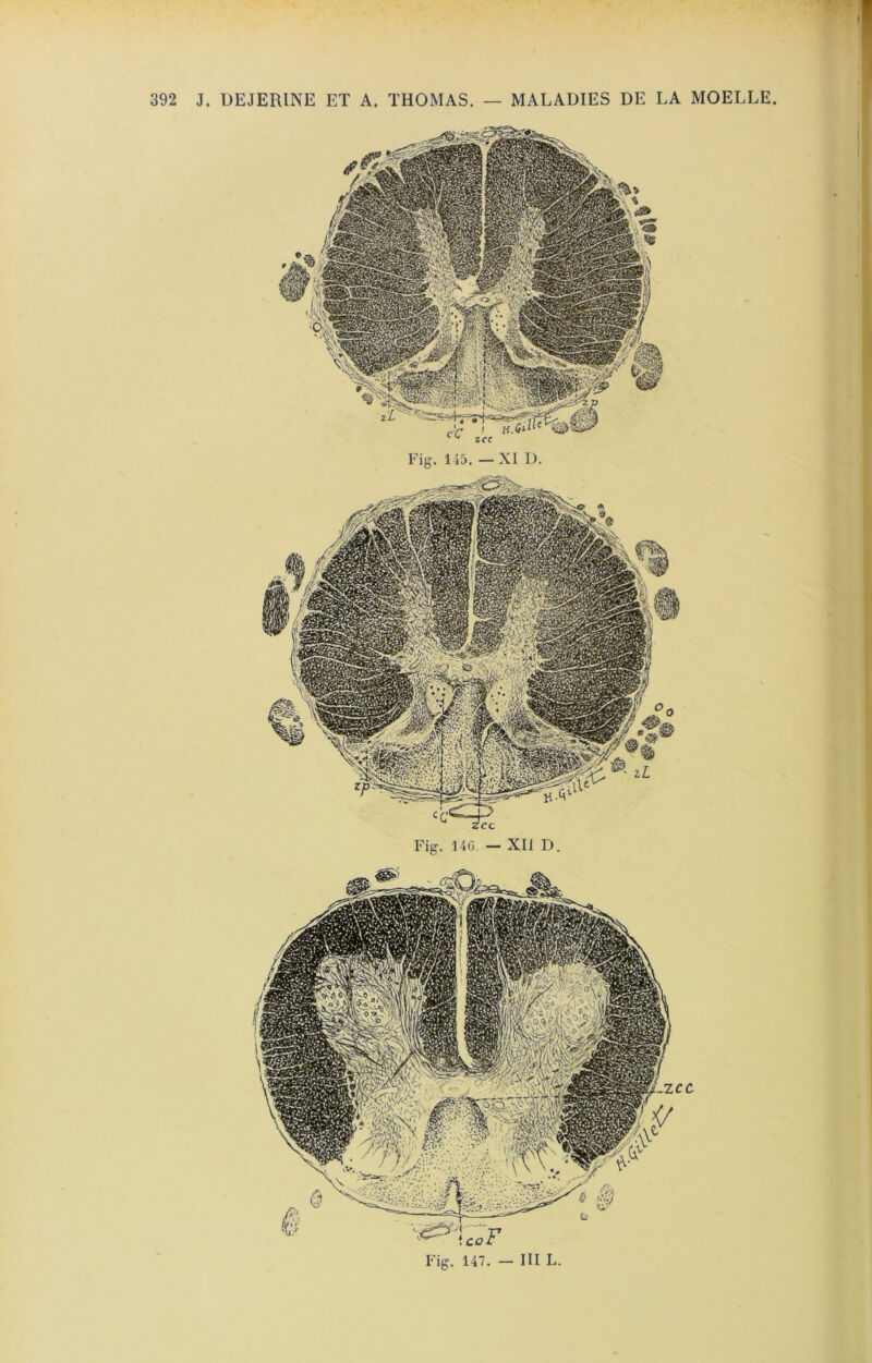 j 392 J. UEJERINE ET A. THOMAS, — MALADIES DE LA MOELLE. Fig. 14G. —- XII D. Fig. 147. — III L.