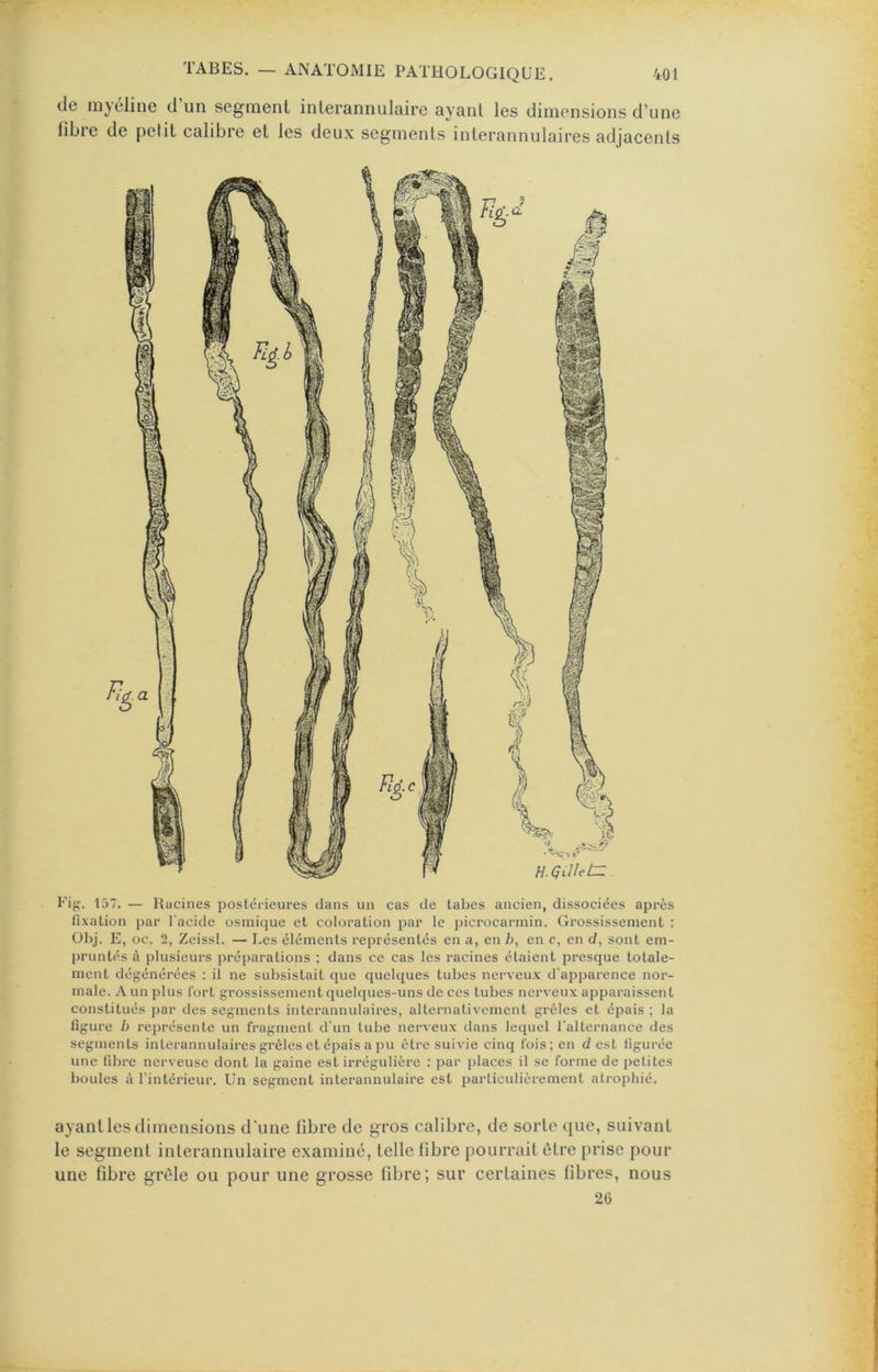 de myéline d un segment inlerannulaire ayant les dimensions d’une fibie de petit calibre et les deux segments interannulaires adjacents Fig. 157. — Racines postérieures clans un cas de tabes ancien, dissociées après fixation par l'acide osmiciue et coloration par le picrocarmin. Grossissement : ühj. E, oc. 2, Zcissl. — I.cs éléments représentés en a, en h, en c, en d, sont em- pruntés à plusieurs préparations ; dans ce cas les racines étaient presque totale- ment dégénérées : il ne subsistait c|ue quelcfues tubes nerveu.x d’apparence nor- male. A un plus fort grossissement cjuelcjues-uns de ces tubes nerveux apparaissent constitués par des segments interannidaires, alternativement grêles et épais ; la figure h rej)résente un fragment d'un tube nei’veux dans lequel l’alternance des segments interannulaires grêles et épais a pu être suivie cinq fois; en d est figurée une fibre nerveuse dont la gaine est irrégulière : par places il se forme de petites boules à l’intérieur. Un segment interannulaire est particulièrement atrophié. ayantles dimensions d’une fibre de gros calibre, de sorte que, suivant le segment interannulaire examiné, telle fibre pourrait être prise pour une fibre grêle ou pour une grosse fibre; sur certaines fibres, nous 2G