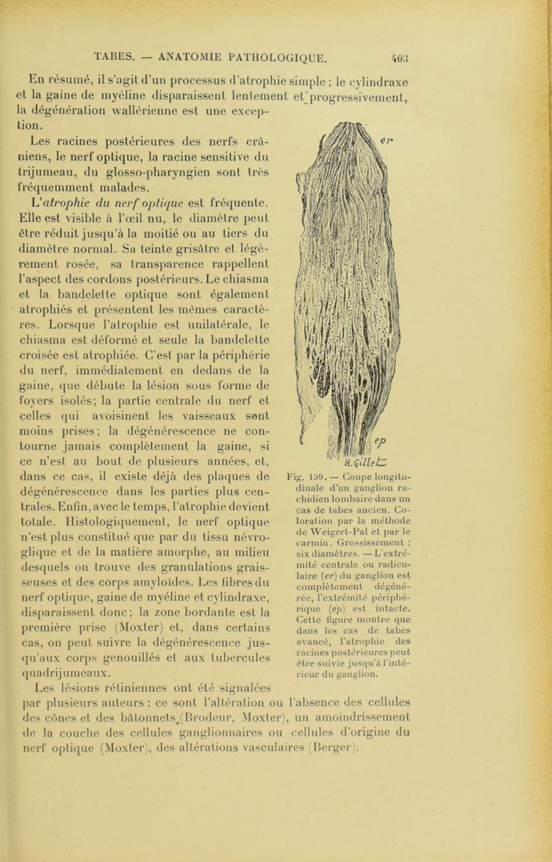 En résumé, il s’ogil d’un processus d’atrophie simple ; le cylindraxe et la gaine de myéline disparaissent lentement et’progressivement, la dégénération wallérienne est une excep- tion. Les racines postérieures des nerfs crA- niens, le nerf optique, la racine sensitive du trijumeau, du glosso-pharyngien sont très fréquemment malades. V.'atrophie du nerf optique est fréquente. Elle est visible à l’œil nu, le diamètre peut être réduit jusqu’à la moitié ou au tiers du diamètre normal. Sa teinte grisâtre et légè- rement rosée, sa transparence rappellent l’aspect des cordons postérieurs. Le chiasma et la bandelette optique sont également atrophiés et présentent les mêmes caractè- res. Lorsque l’atrophie est unilatérale, le chiasma est déformé et seule la bandelette croisée est atrophiée. C’est par la périphérie du nerf, immédiatement en dedans de la gaine, que débute la lésion sous forme de foyers isolés; la partie centrale du nerf et celles (jui avoisinent les vaisseaux sont moins prises; la dégénérescence ne con- tourne jamais complètement la gaine, si ce n’est au bout de plusieurs années, et, dans ce cas, il existe déjà des plaques de dégénérescence dans les parties plus cen- trales. Enfin, avec le temps, l’atrophie devient totale. Ilistologiciuement, le nerf optique n’est plus constitué que par du tissu névro- glique et de la matière amorphe, au milieu desciuels on trouve des granulations grais- seuses et des corps amyloïdes. Les fdjresdu nerf optique, gaine de myéline et cylindraxe, dis|)araissent donc; la zone bordante est la première prise (Moxter) et, dans certains cas, on peut suivre la dégénérescence jus- qu’aux corps genouillés et aux tubercules quadrijumeaux. Fig. 139.— Coupe longitu- dinale d’un ganglion ra- chidien lombaire dans un cas de tabes ancien. Co- loration par la méthode de Weigert-Pal et par le carmin. Grossissement : si.x diamètres. — L’extré- mité centrale ou radicu- laire (er) du ganglion est complètement dégéné- rée, l’extrémilé périphé- rique (ep) est intacte. Cette figure montre que dans les cas de tabes avancé, l’atrophie des racines postérieures peut être suivie jusqu’à l’inté- rieur du ganglion. Les lésions rétiniennes ont été signalées par plusieurs auteurs : ce sont l’alléralion ou l’absence des cellules des cônes et des bâtonnets^fBrodeur, Moxter), un amoindrissement <le la couche des cellules ganglionnaires ou cellules d'origine du nerf optique (Moxter), des altérations vasculaires (Berger).
