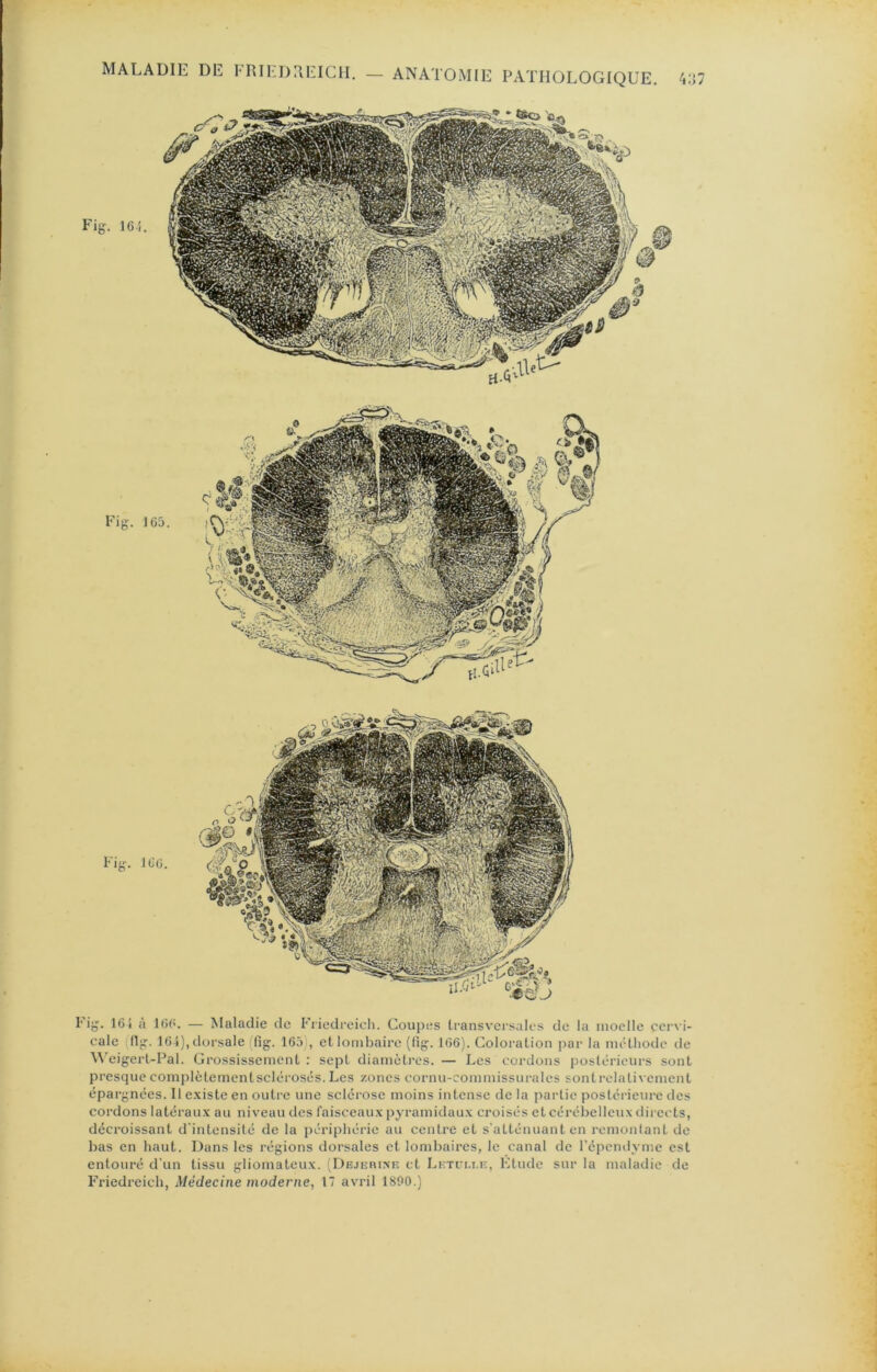 l'ig. 16i a l()<î. — Maladie de Fiiedrcicli. Coupes transversales de la moelle ccr\i- cale fljr. 16 î), dorsale (fig. 165), etloinbaire (fig. 166). Coloration par la métliodc de \N'eigert-Fal. Grossissement : sept diamètres. — Les cordons postérieurs sont presque complètementsclérosés. Les zones cornu-commissurales sontrelati\ ement épargnées. Il e.xiste en outre une sclérose moins intense de la partie postérieure des cordons latérau.v au niveau des faisceaux pyramidaux croisés et cérébelleux directs, décroissant d'intensité de la périphérie au centre et s'atténuant en rcmonlant de bas en haut. Dans les régions dorsales et lombaires, le canal de l’épendyme est entouré d’un tissu gliomateux. (Dejerink et Li-Tri.r.n, Etude sur la maladie de Friedreicli, Médecine moderne, 17 avril 1890.)