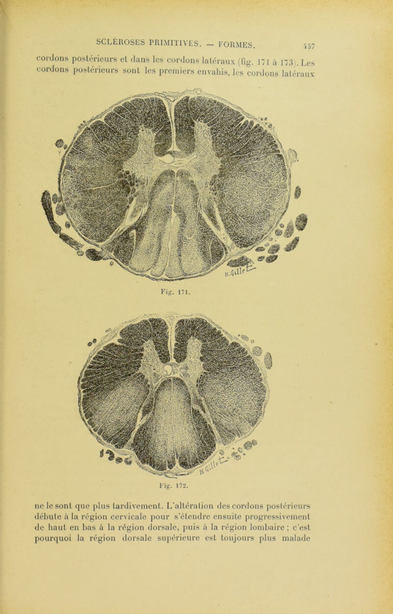 cordons postérieurs et dans les cordons latéraux (fig. 171 ù 173). Les cordons postérieurs sont les premiers envahis, les cordons latéraux Fig. 171. Fig. 172. ne le sont que plus tardivement. L’altération des cordons postérieurs débute <à la région cervicale pour s’étendre ensuite progressivement de haut en bas à la région dorsale, puis à la région lombaire ; c'est pourquoi la région dorsale supérieure est toujours plus malade