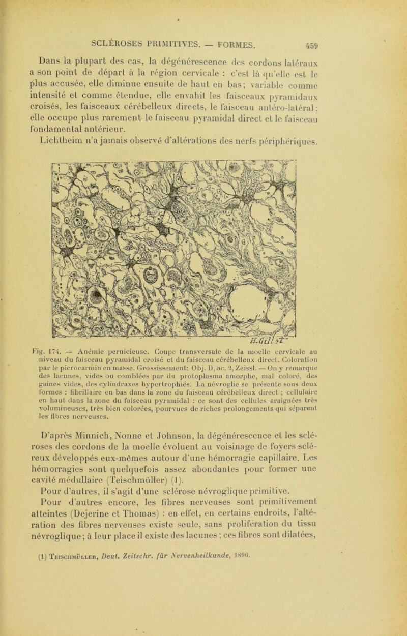 bans la plupart des cas, la dégénérescence des cordons latéraux a son point de départ à la région cervicale : c’est là qu’elle est le plus accusée, elle diminue ensuite de haut en bas; variable comme intensité et comme étendue, elle envahit les faisceaux pyramidaux croisés, les faisceaux cérébelleux directs, le faisceau anléro-latéral ; elle occupe plus rarement le faisceau pyramidal direct et le faisceau fondamental antérieur. Lichtheim n’a jamais observé d’altérations des nerfs périphéri({ues. Fig. 174. — Anémie pernicieuse. Coupe transversale de la moelle cervicale au niveau du faisceau pyramidal croisé et du faisceau cérébelleux direct. Coloration par 1e picrocarmin en masse. Grossissement: Obj. D,oc. 2, Zeissl. — On y remarque des lacunes, vides ou comblées par du protoplasma amorphe, mal coloré, des gaines vides, des cylindraxes hypertrophiés. La névroglie se présente sous deux formes : fibrillaire en bas dans la zone du faisceau cérébelleux direct ; cellulaire en haut dans la zone du faisceau pyramidal : ce sont des cellules araignées très volumineuses, très bien colorées, pourvues de riches prolongements qui séparent les fibres nerveuses. D’après Minnich, Nonne et Johnson, la dégénérescence et les sclé- roses des cordons de la moelle évoluent au voisinage de foyers sclé- reux développés eux-memes autour d’une hémorragie capillaire. Les hémorragies sont quelquefois assez abondantes pour former une cavité médullaire (Teischmüller) (J). Pour d’autres, il s’agit d’une sclérose névroglique primitive. Pour d'autres encore, les fibres nerveuses sont primilivemenl atteintes (Üejerine et Thomas) : en elTet, en certains cntlroils, l'alté- ration des fibres nerveuses e.xiste seule, sans proliféralion du tissu névroglique ; à leur place il existe des lacunes ; ces fibres sont dilatées, (1) Teischmüller, Deul. Zeilschr. für yervenheilkunde, 189G.