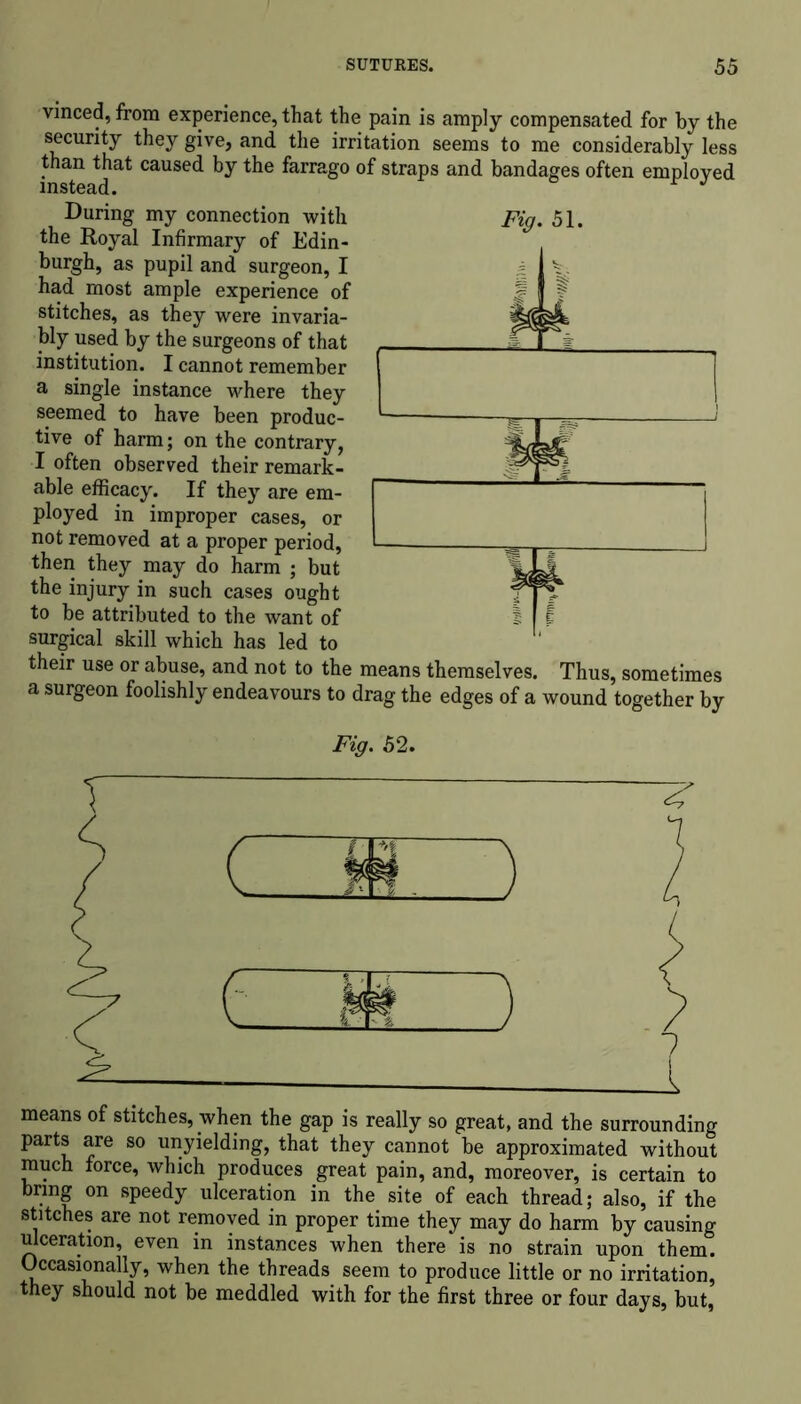 vmced, from experience, that the pain is amply compensated for by the security they give, and the irritation seems to me considerably less than that caused by the farrago of straps and bandages often employed instead. r J Fig. 51 During my connection with the Royal Infirmary of Edin- burgh, as pupil and surgeon, I had most ample experience of stitches, as they were invaria- bly used by the surgeons of that institution. I cannot remember a single instance where they seemed to have been produc- tive of harm; on the contrary, I often observed their remark- able efficacy. If they are em- ployed in improper cases, or not removed at a proper period, then they may do harm ; but the injury in such cases ought to be attributed to the want of surgical skill which has led to their use or abuse, and not to the means themselves. Thus, sometimes a surgeon foolishly endeavours to drag the edges of a wound together by Fig. 52. 4* c ) t 7 means of stitches, when the gap is really so great, and the surrounding parts are so unyielding, that they cannot be approximated without much force, which produces great pain, and, moreover, is certain to bring on speedy ulceration in the site of each thread; also, if the stitches are not removed in proper time they may do harm by causing ulceration, even in instances when there is no strain upon them. Occasionally, when the threads seem to produce little or no irritation, they should not be meddled with for the first three or four days, but,