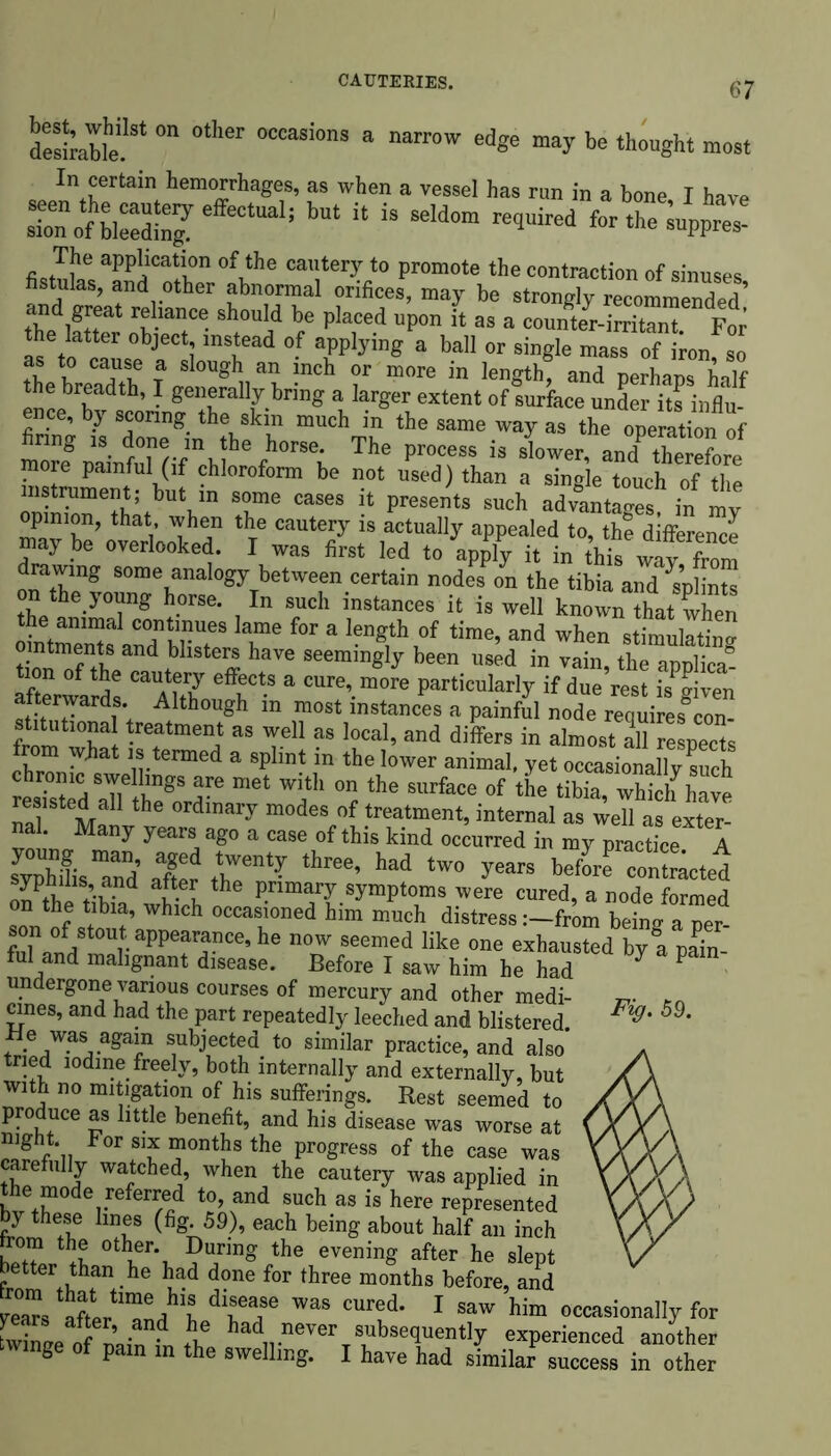 CAUTERIES. desirable!8* °“ °“as!onS 8 narrOW ed*e be *b°«gbt most In certain hemorrhages, as when a vessel has run in a bone I have rotbiS5 ^ * iS S6ld0m *** for the^uppres- The application of the cautery to promote the contraction of sinuses fistulas, and other abnormal orifices, may be strongly recommended’ tTeV+r1 vTe sh0U!d be placed upon h as a counter-irritant For Is to caused 1 Th** ° ?plying * bal1 °r §ingle mass of iron’ 80 l , f a slou8h an lnch or more in length, and perhaps half the breadth, I generally bring a larger extent of surface under its inflm ence, by scoring the skin much in the same way as the operation of finng is done in the horse. The process is slower, and tWore more painful (if chloroform be not used) than a single touch of the instrument; but in some cases it presents such advantages in 1 opinion, that when the cautery is actually appealed to, the difference maybe overlooked. I was first led to apply it in this wav’from drawing some analogy between certain nodes on the tibia an™ m nS on the young horse. In such instances it is well known thatthen the animal continues lame for a length of time, and when stimulatino- &n”rtheTadtb lSteff haT<! Seemin^ been used in ™in, the applica”- tion of the cautery effects a cure, more particularly if due rest isffiven afterwards. Although in most instances a painful node requires^on- stitutmnal treatment as well as local, and differs in almost all respects from what is termed a splint in the lower animal, yet occasionally such rC/rbngS 5re met with on the surface of the tibia, which have resisted all the ordinary modes of treatment, internal as well as exter- nal. Many years ago a case of this kind occurred in my practice A s™\lsTd\Xr rnty three’ “ tW° yeaK bcf^ contracted on the tiSd l l h Pnmary symptoms were cured, a node formed on the tibia, which occasioned him much distressfrom being a ner fiT^/ r appearance’ he now seemed like one exhausted by a pain- ful and malignant disease. Before I saw him he had 7 P undergone various courses of mercury and other medi- cines, and had the part repeatedly leeched and blistered. Be was again subjected to similar practice, and also tried iodine freely, both internally and externally, but with no mitigation of his sufferings. Rest seemed to produce as little benefit, and his disease was worse at night For six months the progress of the case was carefully watched, when the cautery was applied in the mode referred to, and such as is here represented by these lines (fig. 59), each being about half an inch f °tber\ ^mg th« evening after he slept better than he had done for three months before, and vitadirr Was cured- 1 saw him occasionally for fringe ofmin h. Jif had ^er subsequently experienced another g p n in the swelling. I have had similar success in other Fig. 59.