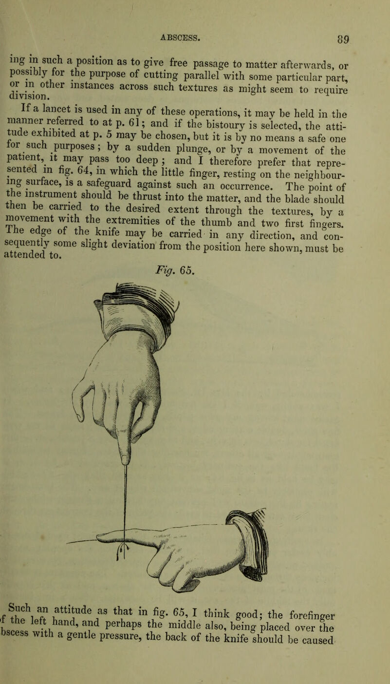 mg m such a position as to give free passage to matter afterwards, or possibly for the purpose of cutting parallel with some particular part, or in other instances across such textures as might seem to require If a lancet is used in any of these operations, it may be held in the manner referred to at p. 61; and if the bistoury is selected, the atti- tude exhibited at p. 5 may be chosen, but it is h\ no means a safe one tor such purposes; by a sudden plunge, or by a movement of the patient, it may pass too deep ; and I therefore prefer that repre- sented in fig. 64, in which the little finger, resting on the neighbour- ing surface, is a safeguard against such an occurrence. The point of the instrument should be thrust into the matter, and the blade should then be carried to the desired extent through the textures, by a movement with the extremities of the thumb and two first fingers. The edge of the knife may be carried in any direction, and con- sequently some slight deviation from the position here shown, must be attended to. 5 Fig. 65.