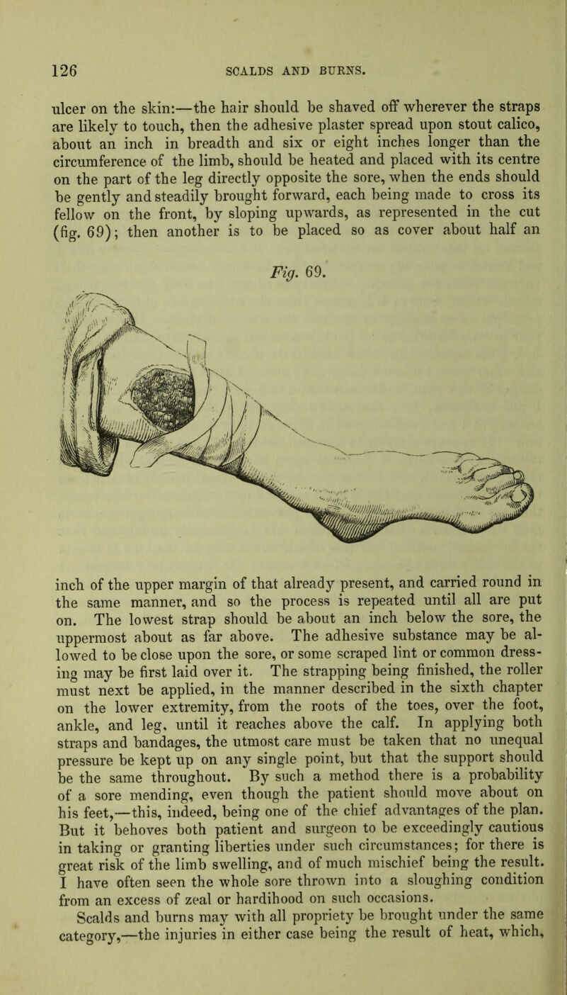 ulcer on the skin:—the hair should be shaved off wherever the straps are likely to touch, then the adhesive plaster spread upon stout calico, about an inch in breadth and six or eight inches longer than the circumference of the limb, should be heated and placed with its centre on the part of the leg directly opposite the sore, when the ends should be gently and steadily brought forward, each being made to cross its fellow on the front, by sloping upwards, as represented in the cut (fig. 69); then another is to be placed so as cover about half an Fig. 69. inch of the upper margin of that already present, and carried round in the same manner, and so the process is repeated until all are put on. The lowest strap should be about an inch below the sore, the uppermost about as far above. The adhesive substance may be al- lowed to be close upon the sore, or some scraped lint or common dress- ing may be first laid over it. The strapping being finished, the roller must next be applied, in the manner described in the sixth chapter on the lower extremity, from the roots of the toes, over the foot, ankle, and leg, until it reaches above the calf. In applying both straps and bandages, the utmost care must be taken that no unequal pressure be kept up on any single point, but that the support should be the same throughout. By such a method there is a probability of a sore mending, even though the patient should move about on his feet,—this, indeed, being one of the chief advantages of the plan. But it behoves both patient and surgeon to be exceedingly cautious in taking or granting liberties under such circumstances; for there is great risk of the limb swelling, and of much mischief being the result. I have often seen the whole sore thrown into a sloughing condition from an excess of zeal or hardihood on such occasions. Scalds and burns may with all propriety be brought under the same category,—the injuries in either case being the result of heat, which,