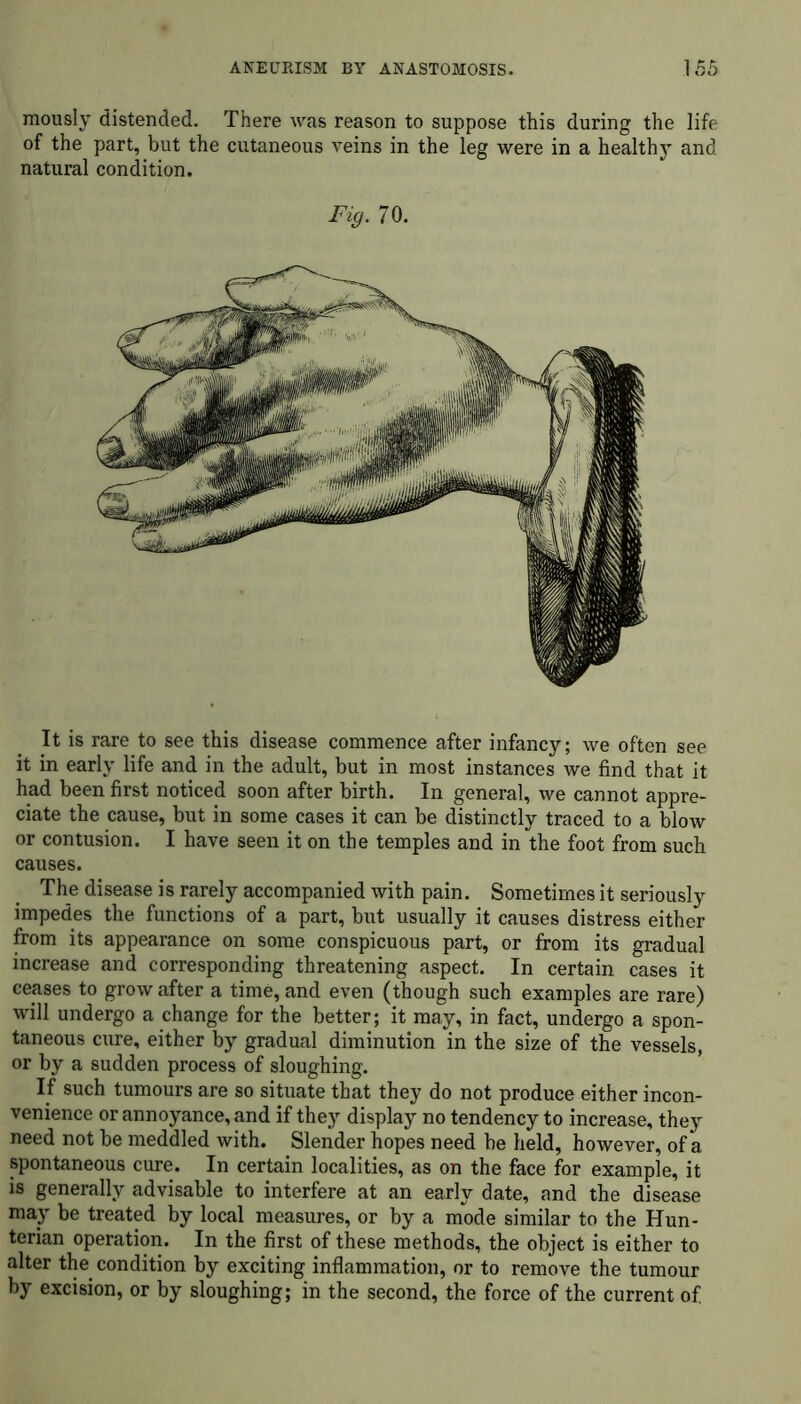 mously distended. There was reason to suppose this during the life of the part, but the cutaneous veins in the leg were in a health}- and natural condition. Fig. 70. It is rare to see this disease commence after infancy; we often see it in early life and in the adult, but in most instances we find that it had been first noticed soon after birth. In general, we cannot appre- ciate the cause, but in some cases it can be distinctly traced to a blow or contusion. I have seen it on the temples and in the foot from such causes. The disease is rarely accompanied with pain. Sometimes it seriously impedes the functions of a part, but usually it causes distress either from its appearance on some conspicuous part, or from its gradual increase and corresponding threatening aspect. In certain cases it ceases to grow after a time, and even (though such examples are rare) will undergo a change for the better; it may, in fact, undergo a spon- taneous cure, either by gradual diminution in the size of the vessels, or by a sudden process of sloughing. If such tumours are so situate that they do not produce either incon- venience or annoyance, and if they display no tendency to increase, they need not be meddled with. Slender hopes need be held, however, of a spontaneous cure. In certain localities, as on the face for example, it is generally advisable to interfere at an early date, and the disease may be treated by local measures, or by a mode similar to the Hun- terian operation. In the first of these methods, the object is either to alter the condition by exciting inflammation, or to remove the tumour by excision, or by sloughing; in the second, the force of the current of