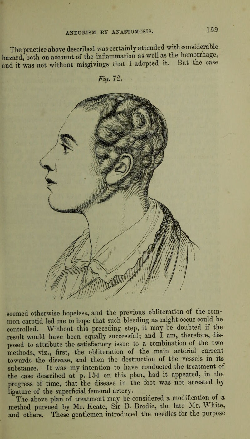 The practice above described was certainly attended with considerable hazard, both on account of the inflammation as well as the hemorrhage, and it was not without misgivings that I adopted it. But the case Fig. 72. seemed otherwise hopeless, and the previous obliteration of the com- mon carotid led me to hope that such bleeding as might occur could be controlled. Without this preceding step, it may be doubted if the result would have been equally successful; and I am, therefore, dis- posed to attribute the satisfactory issue to a combination of the two methods, viz., first, the obliteration of the main arterial current towards the disease, and then the destruction of the vessels in its substance. It was my intention to have conducted the treatment of the case described at p. 154 on this plan, had it appeared, in the progress of time, that the disease in the foot was not arrested by ligature of the superficial femoral artery. The above plan of treatment may be considered a modification of a method pursued by Mr. Keate, Sir B. Brodie, the late Mr. White, and others. These gentlemen introduced the needles for the purpose