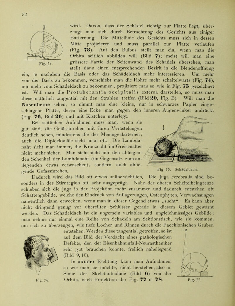 wird. Davon, dass der Schädel richtig zur Platte liegt, über- zeugt man sich durch Betrachtung des Gesichts aus einiger Entfernung. Die Mittellinie des Gesichts muss sich in dessen Mitte projizieren und muss parallel zur Platte verlaufen (Fig. 73). Auf den Bulbus stellt man ein, wenn man die Orbita seitlich abbilden will (Bild 7); meist will man eine grössere Partie der Seitenwand des Schädels übersehen, man stellt dann einen entsprechenden Bezirk in die Blendenöffnung ein, je nachdem die Basis oder das Schädeldach mehr interessieren. Um mehr von der Basis zu bekommen, verschiebt man die Röhre mehr scheitelwärts (Fig. 74), um mehr vom Schädeldach zu bekommen, projiziert man so wie in Fig. 75 gezeichnet ist. Will man die Protuberantia occipitalis externa darstellen, so muss man diese natürlich tangential mit den Strahlen treffen (Bild 20, Fig. B). Will man die Nasenbeine sehen, so nimmt man eine kleine, nur in schwarzes Papier einge- schlagene Platte, deren eine Ecke man gegen den inneren Augenwinkel andrückt (Fig. 76, Bild 26) und mit Kistchen unterlegt. Bei seitlichen Aufnahmen muss man, wenn sie gut sind, die Gefässfurchen mit ihren Verästelungen deutlich sehen, mindestens die der Meningealarterien; auch die Diploekanäle sieht man oft. Die Lambda- naht sieht man immer, die Kranznaht im Greisenalter nicht mehr sicher. Man sieht nicht nur den abliegen- den Schenkel der Lambdanaht (im Gegensatz zum an- liegenden etwas verwaschen), sondern auch ablie- gende Gefässfurchen. Dadurch wird das Bild oft etwas unübersichtlich, sonders in der Stirnregion oft sehr ausgeprägt. Fig. /5. Schädeldach. Die Juga cerebralia sind be- Nahe der oberen Scheitelbeingrenze schieben sich die Juga in der Projektion mehr zusammen und dadurch entstehen oft Schattengebilde, welche den Eindruck von Auflagerungen, Osteophyten, Verwachsungen namentlich dann erwecken, wenn man in dieser Gegend etwas „sucht“. Es kann aber nicht dringend genug vor übereilten Schlüssen gerade in diesem Gebiet gewarnt werden. Das Schädeldach ist ein ungemein variables und ungleichmässiges Gebilde; man nehme nur einmal eine Reihe von Schädeln am Sektionstisch, wie sie kommen, um sich zu überzeugen, wie tiefe Löcher und Rinnen durch die Pacchionischen Gruben entstehen. Werden diese tangential getroffen, so ist auf dem Bild der Verdacht eines pathologischen ji Defekts, den der Eisenbahnunfall-Neurastheniker jj sehr gut brauchen könnte, freilich naheliegend (Bild 9, 10). In axialer Richtung kann man Aufnahmen, so wie man sie möchte, nicht hersteilen, also im Sinne der Skeletaufnahme (Bild 6) von der Fig. 76. Orbita, nach Projektion der Fig. 77 u. 78.