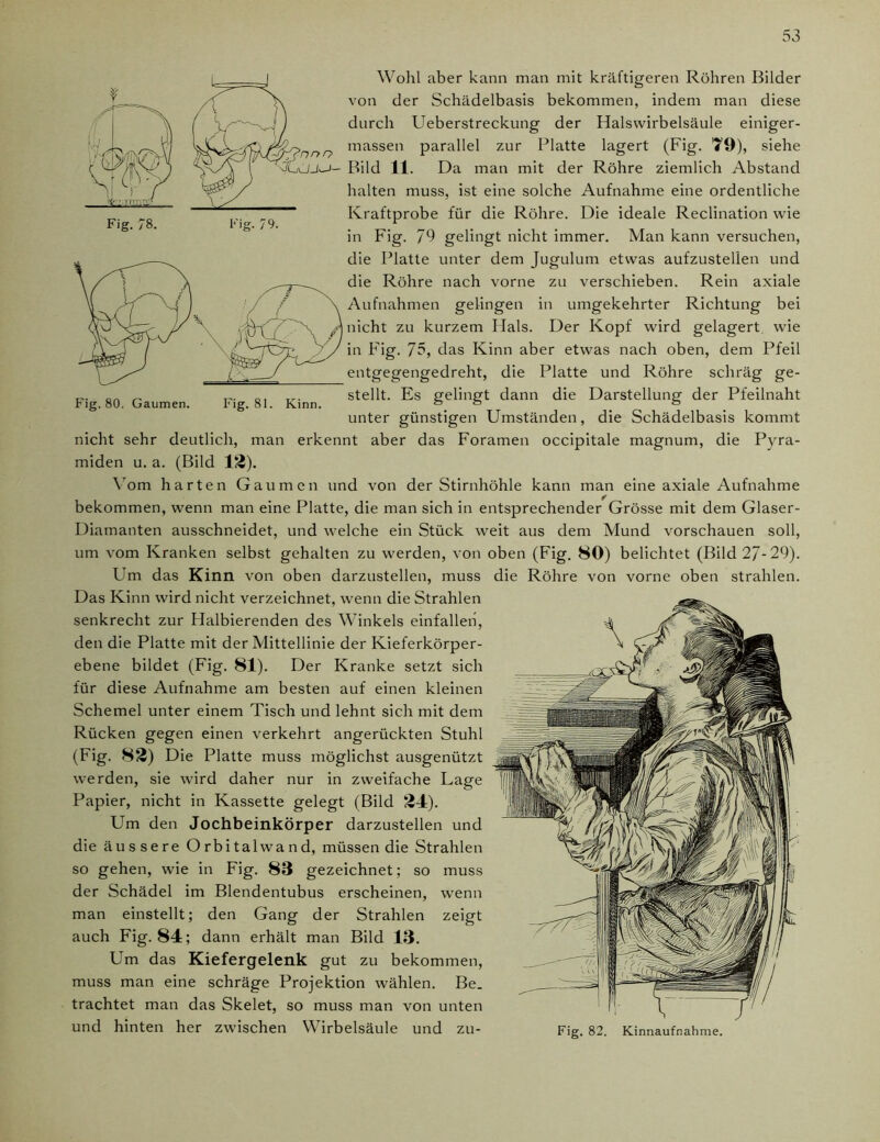 Fig. 78. Fig. 79. Fig. 80. Gaumen. Fig. 81. Kinn. Wohl aber kann man mit kräftigeren Röhren Bilder von der Schädelbasis bekommen, indem man diese durch Ueberstreckung der Halswirbelsäule einiger- ■nnr> massen parallel zur Platte lagert (Fig. 79), siehe Bild 11. Da man mit der Röhre ziemlich Abstand halten muss, ist eine solche Aufnahme eine ordentliche Kraftprobe für die Röhre. Die ideale Reclination wie in Fig. 79 gelingt nicht immer. Man kann versuchen, die Platte unter dem Jugulum etwas aufzustellen und die Röhre nach vorne zu verschieben. Rein axiale Aufnahmen gelingen in umgekehrter Richtung bei nicht zu kurzem Hals. Der Kopf wird gelagert wie in Fig. J5, das Kinn aber etwas nach oben, dem Pfeil entgegengedreht, die Platte und Röhre schräg ge- stellt. Es gelingt dann die Darstellung der Pfeilnaht unter günstigen Umständen, die Schädelbasis kommt nicht sehr deutlich, man erkennt aber das Foramen occipitale magnum, die Pyra- miden u. a. (Bild 12). Vom harten Gaumen und von der Stirnhöhle kann man eine axiale Aufnahme bekommen, wenn man eine Platte, die man sich in entsprechender Grösse mit dem Glaser- Diamanten ausschneidet, und welche ein Stück weit aus dem Mund Vorschauen soll, um vom Kranken selbst gehalten zu werden, von oben (Fig. 80) belichtet (Bild 27-29). Um das Kinn von oben darzustellen, muss die Röhre von vorne oben strahlen. Das Kinn wird nicht verzeichnet, wenn die Strahlen senkrecht zur Halbierenden des Winkels einfallen, den die Platte mit der Mittellinie der Kieferkörper- ebene bildet (Fig. 81). Der Kranke setzt sich für diese Aufnahme am besten auf einen kleinen Schemel unter einem Tisch und lehnt sich mit dem Rücken gegen einen verkehrt angerückten Stuhl (Fig. 82) Die Platte muss möglichst ausgenützt werden, sie wird daher nur in zweifache Lage Papier, nicht in Kassette gelegt (Bild 24). Um den Jochbeinkörper darzustellen und die äussere Orbitalwand, müssen die Strahlen so gehen, wie in Fig. 83 gezeichnet; so muss der Schädel im Blendentubus erscheinen, wenn man einstellt; den Gang der Strahlen zeigt auch Fig. 84; dann erhält man Bild 13. Um das Kiefergelenk gut zu bekommen, muss man eine schräge Projektion wählen. Be. trachtet man das Skelet, so muss man von unten und hinten her zwischen Wirbelsäule und zu- Fig. 82. Kinnaufnahme.