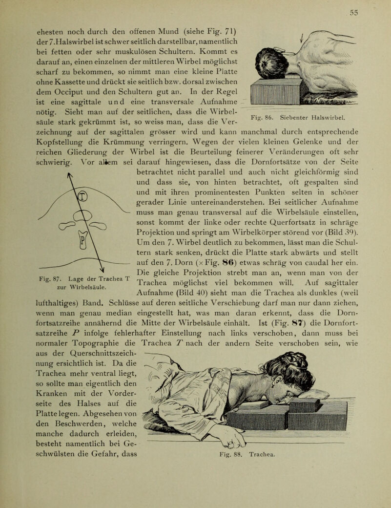 Fi?. 86. Siebenter Halswirbel. ehesten noch durch den offenen Mund (siehe Fig. 71) der 7.Halswirbel ist schwer seitlich darstellbar, namentlich bei fetten oder sehr muskulösen Schultern. Kommt es darauf an, einen einzelnen der mittleren Wirbel möglichst scharf zu bekommen, so nimmt man eine kleine Platte ohne Kassette und drückt sie seitlich bzw. dorsal zwischen dem Occiput und den Schultern gut an. In der Regel ist eine sagittale und eine transversale Aufnahme nötig. Sieht man auf der seitlichen, dass die Wirbel- säule stark gekrümmt ist, so weiss man, dass die Ver- zeichnung auf der sagittalen grösser wird und kann manchmal durch entsprechende Kopfstellung die Krümmung verringern. Wegen der vielen kleinen Gelenke und der reichen Gliederung der Wirbel ist die Beurteilung feinerer Veränderungen oft sehr schwierig. Vor aliem sei darauf hingewiesen, dass die Dornfortsätze von der Seite betrachtet nicht parallel und auch nicht gleichförmig sind und dass sie, von hinten betrachtet, oft gespalten sind und mit ihren prominentesten Punkten selten in schöner gerader Linie untereinanderstehen. Bei seitlicher Aufnahme muss man genau transversal auf die Wirbelsäule einstellen, sonst kommt der linke oder rechte Querfortsatz in schräge Projektion und springt am Wirbelkörper störend vor (Bild 39). Um den 7- Wirbel deutlich zu bekommen, lässt man die Schul- tern stark senken, drückt die Platte stark abwärts und stellt auf den 7. Dorn (x Fig. 86) etwas schräg von caudal her ein. Die gleiche Projektion strebt man an, wenn man von der Fig. 87. Lage ^er Trachea l Trachea möglichst viel bekommen will. Auf sagittaler Aufnahme (Bild 40) sieht man die Trachea als dunkles (weil lufthaltiges) Band. Schlüsse auf deren seitliche Verschiebung darf man nur dann ziehen, wenn man genau median eingestellt hat, was man daran erkennt, dass die Dorn- fortsatzreihe annähernd die Mitte der Wirbelsäule einhält. Ist (Fig. 87) die Dornfort- satzreihe P infolge fehlerhafter Einstellung nach links verschoben, dann muss bei normaler Topographie die Trachea T nach der andern Seite verschoben sein, wie aus der Querschnittszeich- nung ersichtlich ist. Da die Trachea mehr ventral liegt, so sollte man eigentlich den Kranken mit der Vorder- seite des Halses auf die Platte legen. Abgesehen von den Beschwerden, welche manche dadurch erleiden, besteht namentlich bei Ge- schwülsten die Gefahr, dass Fig. 88. Trachea.