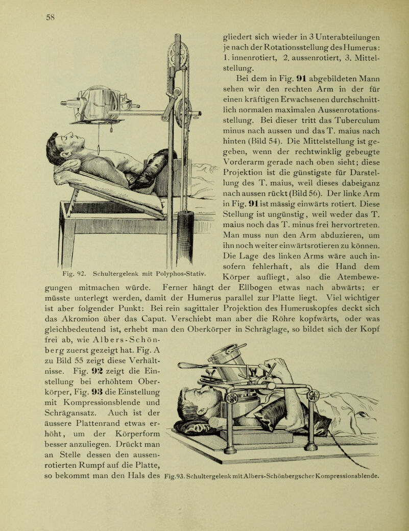 gliedert sich wieder in 3 Unterabteilungen je nach der Rotationsstellung desl Iumerus: 1. innenrotiert, 2. aussenrotiert, 3. Mittel- stellung. Bei dem in Fig. 91 abgebildeten Mann sehen wir den rechten Arm in der für einen kräftigen Erwachsenen durchschnitt- lich normalen maximalen Aussenrotations- stellung. Bei dieser tritt das Tuberculum minus nach aussen und das T. maius nach hinten (Bild 54). Die Mittelstellung ist ge- geben, wenn der rechtwinklig gebeugte Vorderarm gerade nach oben sieht; diese Projektion ist die günstigste für Darstel- lung des T. maius, weil dieses dabeiganz nach aussen rückt (Bild 56). Der linke Arm in Fig. 91 ist mässig einwärts rotiert. Diese Stellung ist ungünstig, weil weder das T. maius noch das T. minus frei hervortreten. Man muss nun den Arm abduzieren, um ihn noch weiter einwärtsrotieren zu können. Die Lage des linken Arms wäre auch in- sofern fehlerhaft, als die Fland dem Fig. 92. Schultergelenk mit Polyphos-Stativ. Körper aufliegt, also die Atembewe- gungen mitmachen würde. Ferner hängt der Ellbogen etwas nach abwärts; er müsste unterlegt werden, damit der Humerus parallel zur Platte liegt. V iel wichtiger ist aber folgender Punkt: Bei rein sagittaler Projektion des Ilumeruskopfes deckt sich das Akromion über das Caput. Verschiebt man aber die Röhre kopfwärts, oder was gleichbedeutend ist, erhebt man den Oberkörper in Schräglage, so bildet sich der Kopf frei ab, wie Alb e rs - Schön- berg zuerst gezeigt hat. Fig. A zu Bild 55 zeigt diese Verhält- nisse. Fig. 93 zeigt die Ein- stellung bei erhöhtem Ober- körper, Fig. 93 die Einstellung mit Kompressionsblende und Schrägansatz. Auch ist der äussere Plattenrand etwas er- höht , um der Körperform besser anzuliegen. Drückt man an Stelle dessen den aussen- rotierten Rumpf auf die Platte, SO bekommt man den Hals des Fig.93.SchultergelenkmitAlbers-SchönbergscherKompressionsblende.