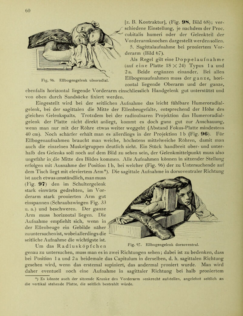[z. B. Kontraktur], (Fig. 98, Bild 68); ver- schiedene Einstellung, je nachdem der Proc. cubitalis humeri oder der Gelenkteil der Vorderarmknochen dargestellt werden sollen. 5. Sagittalaufnahme bei proniertem Vor- derarm (Bild 67). Als Regel gilt eine D o p p e 1 a u f n a h m e (auf eine Platte 18X24) Typus la und 2 a. Beide ergänzen einander. Bei allen Ellbogenaufnahmen muss der ganze, hori- zontal liegende Oberarm und der ganze, ebenfalls horizontal liegende Vorderarm einschliesslich Handgelenk gut unterstützt und von oben durch Sandsäcke fixiert werden. Eingestellt wird bei der seitlichen Aufnahme das leicht fühlbare Humeroradial- gelenk, bei der sagittalen die Mitte der Ellenbeugefalte, entsprechend der Höhe des gleichen Gelenkspalts. Trotzdem bei der radioulnaren Projektion das Humeroradial- gelenk der Platte nicht direkt anliegt, kommt es doch ganz gut zur Anschauung, wenn man nur mit der Röhre etwas weiter weggeht (Abstand Fokus-Platte mindestens 40 cm). Noch schärfer erhält man es allerdings in der Projektion 1 b (Fig. 90). Für Ellbogenaufnahmen braucht man weiche, höchstens mittelweiche Röhren, damit man auch die einzelnen Muskelgruppen deutlich sieht. Ein Stück handbreit ober- und unter- halb des Gelenks soll noch auf dem Bild zu sehen sein, der Gelenkmittelpunkt muss also ungefähr in die Mitte des Bildes kommen. Alle Aufnahmen können in sitzender Stellung erfolgen mit Ausnahme der Position 1 b, bei welcher (Fig. 96) der zu Untersuchende auf dem Tisch liegt mit eleviertem Arm*). Die sagittale Aufnahme in dorsoventraler Richtung ist auch etwas umständlich, man muss (Fig. 91) den im Schultergelenk stark einwärts gedrehten, im Vor- derarm stark pronierten Arm gut einspannen (Schraubzwingen Fig. 38 u. a.) und beschweren. Der ganze Arm muss horizontal liegen. Die Aufnahme empfiehlt sich, wenn in der Ellenbeuge ein Gebilde näher zu untersuchen ist, wobei allerdings die seitliche Aufnahme die wichtigste ist. Um das Radiusköpfchen FiS‘ 97' Ellbogengelenk dorsoventral. genau zu untersuchen, muss man es in zwei Richtungen sehen; dabei ist zu bedenken, dass bei Position 1 a und 2 a beidemale das Capitulum in derselben, d. h. sagittalen Richtung gesehen wird, wenn das erstemal supiniert, das andermal proniert wurde. Man wird daher eventuell noch eine Aufnahme in sagittaler Richtung bei halb proniertem *) Es könnte auch der sitzende Kranke den Vorderarm senkrecht aufstellen, angelehnt seitlich an die vertikal stehende Platte, die seitlich bestrahlt würde.