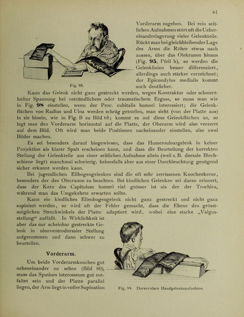 Vorderarm zugeben. Bei rein seit- lichen Aufnahmen stört oft die Ueber- einanderlagerung vieler Gelenkteile. Rückt man bei gleichbleibender Lage des Arms die Röhre etwas nach aussen, über das Olekranon hinaus (Fig. 95, Pfeil b), so werden die Gelenklinien besser differenziert, allerdings auch stärker verzeichnet; der Epicondylus medialis kommt auch deutlicher. Kann das Gelenk nicht ganz gestreckt werden, wegen Kontraktur oder schmerz- hafter Spannung bei entzündlichem oder traumatischem Erguss, so muss man wie in Fig. 98 einstellen, wenn der Proc. cubitalis humeri interessiert; die Gelenk- flächen von Radius und Ulna werden schräg getroffen, man sieht (von der Platte aus) in sie hinein, wie in Fig. B zu Bild 68; kommt es auf diese Gelenkflächen an, so legt man den Vorderarm horizontal auf die Platte, der Oberarm wird also verzerrt auf dem Bild. Oft wird man beide Positionen nacheinander einstellen, also zwei Bilder machen. Es sei besonders darauf hingewiesen, dass das Humeroulnargelenk in keiner Projektion als klarer Spalt erscheinen kann, und dass die Beurteilung der korrekten Stellung der Gelenkteile aus einer seitlichen Aufnahme allein (weil z. B. dorsale Blech- schiene liegt) manchmal schwierig, keinesfalls aber aus einer Durchleuchtung genügend sicher erkannt werden kann. Bei jugendlichen Ellbogengelenken sind die oft sehr zerrissenen Knochenkerne, besonders der des Olecranon zu beachten. Bei kindlichen Gelenken sei daran erinnert, dass der Kern des Capitulum humeri viel grösser ist als der der Trochlea, während man das Umgekehrte erwarten sollte. Kann ein kindliches Ellenbogengelenk nicht ganz gestreckt und nicht ganz supiniert werden, so wird oft der Fehler gemacht, dass die Ebene des grösst- möglichen Streckwinkels der Platte adaptiert wird, wobei eine starke „Valgus- steilung“ auffällt. In Wirklichkeit ist aber das nur scheinbar gestreckte Ge- beurteilen. Vorderarm. Um beide Vorderarmknochen gut nebeneinander zu sehen (Bild SO), muss das Spatium interosseum gut ent- faltet sein und der Platte parallel liegen, der Arm liegt in voller Supination lenk in ulnoventrodorsaler Stellung aufcfenommen und dann schwer zu Fig. 98. Fig. 99. Dorsovolare Handgelenksaufnahme.