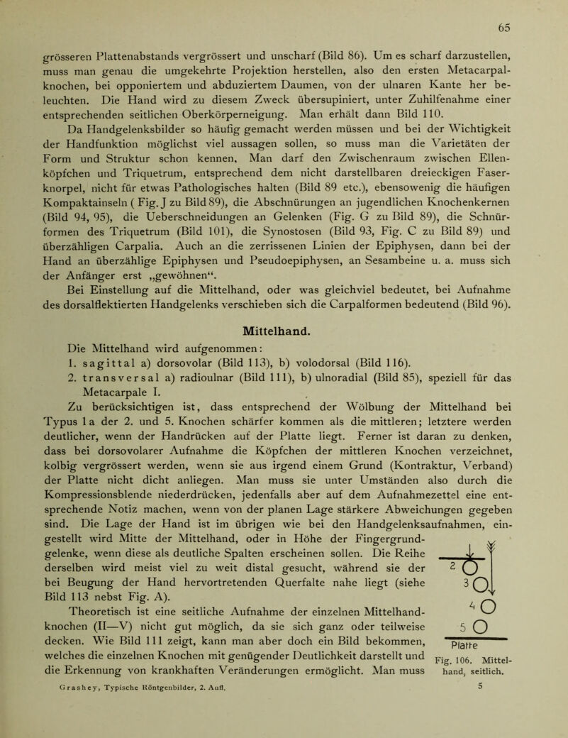 grösseren Plattenabstands vergrössert und unscharf (Bild 86). Um es scharf darzustellen, muss man genau die umgekehrte Projektion hersteilen, also den ersten Metacarpal- knochen, bei opponiertem und abduziertem Daumen, von der ulnaren Kante her be- leuchten. Die Hand wird zu diesem Zweck übersupiniert, unter Zuhilfenahme einer entsprechenden seitlichen Oberkörperneigung. Man erhält dann Bild 110. Da Handgelenksbilder so häufig gemacht werden müssen und bei der Wichtigkeit der Handfunktion möglichst viel aussagen sollen, so muss man die Varietäten der Form und Struktur schon kennen. Man darf den Zwischenraum zwischen Ellen- köpfchen und Triquetrum, entsprechend dem nicht darstellbaren dreieckigen Faser- knorpel, nicht für etwas Pathologisches halten (Bild 89 etc.), ebensowenig die häufigen Kompaktainseln ( Fig. J zu Bild 89), die Abschnürungen an jugendlichen Knochenkernen (Bild 94, 95), die Ueberschneidungen an Gelenken (Fig. G zu Bild 89), die Schnür- formen des Triquetrum (Bild 101), die Synostosen (Bild 93, Fig. C zu Bild 89) und überzähligen Carpalia. Auch an die zerrissenen Linien der Epiphysen, dann bei der Hand an überzählige Epiphysen und Pseudoepiphysen, an Sesambeine u. a. muss sich der Anfänger erst ,,gewöhnen“. Bei Einstellung auf die Mittelhand, oder was gleichviel bedeutet, bei Aufnahme des dorsalflektierten Handgelenks verschieben sich die Carpalformen bedeutend (Bild 96). Mittelhand. Die Mittelhand wird aufgenommen: 1. sagittal a) dorsovolar (Bild 113), b) volodorsal (Bild 116). 2. transversal a) radioulnar (Bild 111), b) ulnoradial (Bild 85), speziell für das Metacarpale I. Zu berücksichtigen ist, dass entsprechend der Wölbung der Mittelhand bei Typus la der 2. und 5. Knochen schärfer kommen als die mittleren; letztere werden deutlicher, wenn der Handrücken auf der Platte liegt. Ferner ist daran zu denken, dass bei dorsovolarer Aufnahme die Köpfchen der mittleren Knochen verzeichnet, kolbig vergrössert werden, wenn sie aus irgend einem Grund (Kontraktur, Verband) der Platte nicht dicht anliegen. Man muss sie unter Umständen also durch die Kompressionsblende niederdriicken, jedenfalls aber auf dem Aufnahmezettel eine ent- sprechende Notiz machen, wenn von der planen Lage stärkere Abweichungen gegeben sind. Die Lage der Hand ist im übrigen wie bei den Handgelenksaufnahmen, ein- gestellt wird Mitte der Mittelhand, oder in Höhe der Fingergrund- gelenke, wenn diese als deutliche Spalten erscheinen sollen. Die Reihe derselben wird meist viel zu weit distal gesucht, während sie der bei Beugung der Hand hervortretenden Querfalte nahe liegt (siehe Bild 113 nebst Fig. A). Theoretisch ist eine seitliche Aufnahme der einzelnen Mittelhand- knochen (II—V) nicht gut möglich, da sie sich ganz oder teilweise decken. Wie Bild 111 zeigt, kann man aber doch ein Bild bekommen, welches die einzelnen Knochen mit genügender Deutlichkeit darstellt und die Erkennung von krankhaften Veränderungen ermöglicht. Man muss 5 3Oj 5 O Platte Fig. 106. Mittel- hand, seitlich. Grashey, Typische Röntgenbilder, 2. Aull.