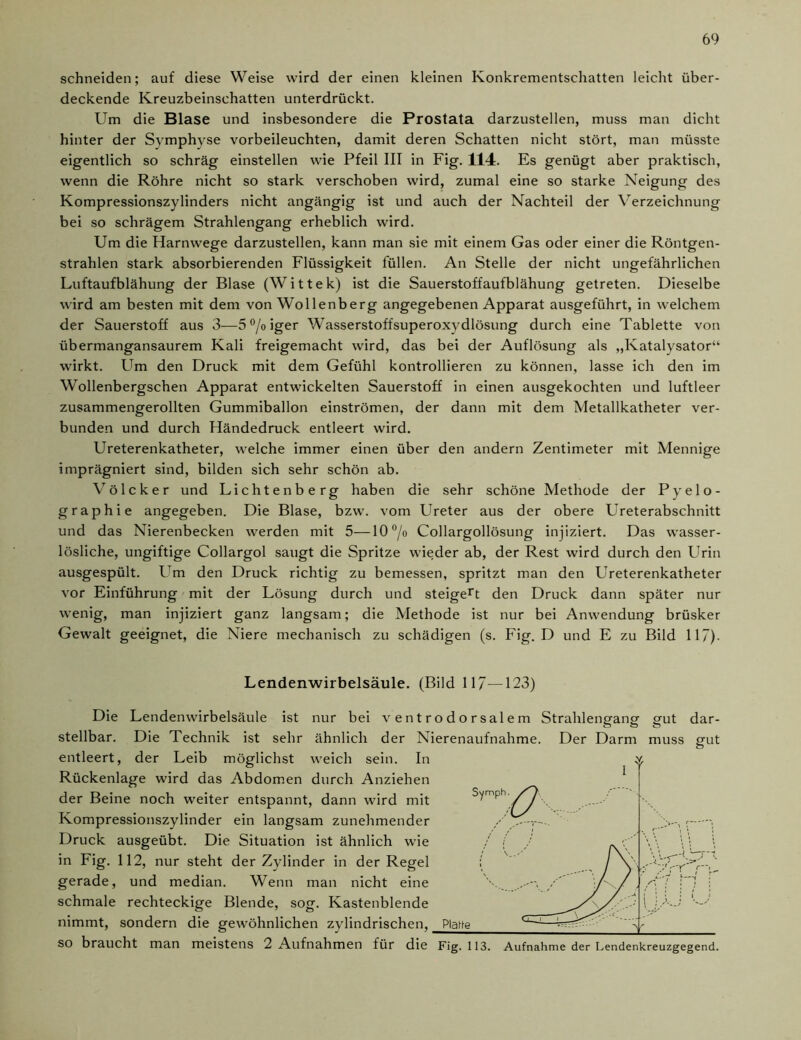schneiden; auf diese Weise wird der einen kleinen Konkrementschatten leicht über- deckende Kreuzbeinschatten unterdrückt. Um die Blase und insbesondere die Prostata darzustellen, muss man dicht hinter der Symphyse vorbeileuchten, damit deren Schatten nicht stört, man müsste eigentlich so schräg einstellen wie Pfeil III in Fig. 114. Es genügt aber praktisch, wenn die Röhre nicht so stark verschoben wird, zumal eine so starke Neigung des Kompressionszylinders nicht angängig ist und auch der Nachteil der Verzeichnung bei so schrägem Strahlengang erheblich wird. Um die Harnwege darzustellen, kann man sie mit einem Gas oder einer die Röntgen- strahlen stark absorbierenden Flüssigkeit füllen. An Stelle der nicht ungefährlichen Luftaufblähung der Blase (Wittek) ist die Sauerstoffaufblähung getreten. Dieselbe wird am besten mit dem von Wollenberg angegebenen Apparat ausgeführt, in welchem der Sauerstoff aus 3—5°/oiger Wasserstoffsuperoxydlösung durch eine Tablette von übermangansaurem Kali freigemacht wird, das bei der Auflösung als „Katalysator“ wirkt. Um den Druck mit dem Gefühl kontrollieren zu können, lasse ich den im Wollenbergschen Apparat entwickelten Sauerstoff in einen ausgekochten und luftleer zusammengerollten Gummiballon einströmen, der dann mit dem Metallkatheter ver- bunden und durch Händedruck entleert wird. Ureterenkatheter, welche immer einen über den andern Zentimeter mit Mennige imprägniert sind, bilden sich sehr schön ab. Vö Icker und Lichtenberg haben die sehr schöne Methode der Pyelo- graphie angegeben. Die Blase, bzw. vom Ureter aus der obere Ureterabschnitt und das Nierenbecken werden mit 5—10 °/o Collargollösung injiziert. Das wasser- lösliche, ungiftige Collargol saugt die Spritze wieder ab, der Rest wird durch den Urin ausgespült. Um den Druck richtig zu bemessen, spritzt man den Ureterenkatheter vor Einführung mit der Lösung durch und steigert den Druck dann später nur wenig, man injiziert ganz langsam; die Methode ist nur bei Anwendung brüsker Gewalt geeignet, die Niere mechanisch zu schädigen (s. Fig. D und E zu Bild 11“). Lendenwirbelsäule. (Bild 117—123) Die Lendenwirbelsäule ist nur bei ventrodorsalem Strahlengang gut dar- stellbar. Die Technik ist sehr ähnlich der Nierenaufnahme. Der Darm muss gut entleert, der Leib möglichst weich sein. In Rückenlage wird das Abdomen durch Anziehen der Beine noch weiter entspannt, dann wird mit Kompressionszylinder ein langsam zunehmender Druck ausgeübt. Die Situation ist ähnlich wie in Fig. 112, nur steht der Zylinder in der Regel gerade, und median. Wenn man nicht eine schmale rechteckige Blende, sog. Kastenblende nimmt, sondern die gewöhnlichen zylindrischen, Platte I ' ' Sy mph. (O J\ / •'Y' c~ 1 ^ Platte t~~—% ✓T/ ;‘7 •; ' SO braucht man meistens 2 Aufnahmen für die Fig. 113. Aufnahme der Lendenkreuzgegend.