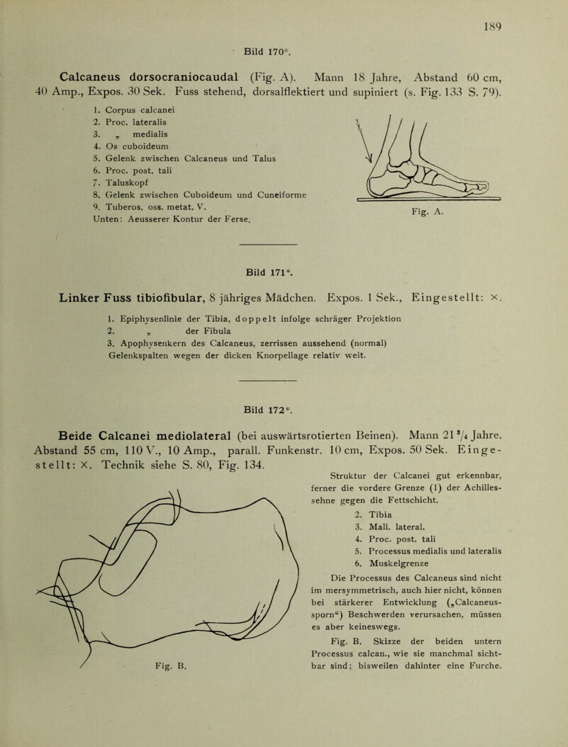 Bild 170*. Calcaneus dorsocraniocaudal (Fig. A). Mann 18 Jahre, Abstand 60 cm, 40 Amp., Expos. 30 Sek. Fuss stehend, dorsalflektiert und supiniert (s. Fig. 133 S. 79). 1. Corpus calcanei 2. Proc. lateralis 3. „ medialis 4. Os cuboideum 5. Gelenk zwischen Calcaneus und Talus 6. Proc. post, tali 7. Taluskopf 8. Gelenk zwischen Cuboideum und Cuneiforme 9. Tuberos. oss. metat. V. Unten: Aeusserer Kontur der Ferse. Bild 171*. Linker Fuss tibiofibular, 8 jähriges Mädchen. Expos. 1 Sek., Eingestellt: x. 1. Epiphysenlinie der Tibia, doppelt infolge schräger Projektion 2. „ der Fibula 3. Apophysenkern des Calcaneus, zerrissen aussehend (normal) Gelenkspalten wegen der dicken Knorpellage relativ weit. Bild 172*. Beide Calcanei mediolateral (bei auswärtsrotierten Beinen). Mann 21 s/< Jahre. Abstand 55 cm, 110 V., 10 Amp., parall. Funkenstr. 10 cm, Expos. 50 Sek. Einge- stellt: X. Technik siehe S. 80, Fig. 134. Struktur der Calcanei gut erkennbar, ferner die vordere Grenze (1) der Achilles- sehne gegen die Fettschicht. 2. Tibia 3. Mali, lateral. 4. Proc. post, tali 5. Processus medialis und lateralis 6. Muskelgrenze Die Processus des Calcaneus sind nicht im mersymmetrisch, auch hier nicht, können bei stärkerer Entwicklung („Calcaneus- sporn“) Beschwerden verursachen, müssen es aber keineswegs. Fig. B. Skizze der beiden untern Processus calcan., wie sie manchmal sicht- bar sind; bisweilen dahinter eine Furche.