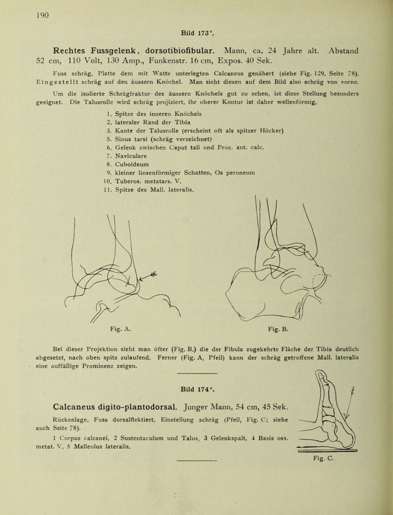 Bild 173*. Rechtes Fussgelenk, dorsotibiofibular. Mann, ca. 24 Jahre alt. Abstand 52 cm, 110 Volt, 130 Amp., Funkenstr. 16 cm, Expos. 40 Sek. Fuss schräg, Platte dem mit Watte unterlegten Calcaneus genähert (siehe Fig. 129, Seite 78). Eingestellt schräg auf den äussern Knöchel. Man sieht diesen auf dem Bild also schräg von vorne. Um die isolierte Schrägfraktur des äussern Knöchels gut zu sehen, ist diese Stellung besonders geeignet. Die Talusrolle wird schräg projiziert, ihr oberer Kontur ist daher wellenförmig. 1. Spitze des inneren Knöchels 2. lateraler Rand der Tibia 3. Kante der Talusrolle (erscheint oft als spitzer Höcker) 5. Sinus tarsi (schräg verzeichnet) 6. Gelenk zwischen Caput tali und Proc. ant. calc. 7- Naviculare 8. Cuboideum 9. kleiner linsenförmiger Schatten, Os peroneum 10. Tuberos. metatars. V. 11. Spitze des Mall, lateralis. Bei dieser Projektion sieht man öfter (Fig. B.) die der Fibula zugekehrte Fläche der Tibia deutlich abgesetzt, nach oben spitz zulaufend. Ferner (Fig. A, Pfeil) kann der schräg getroffene Mall, lateralis eine auffällige Prominenz zeigen. Bild 174*. Calcaneus digito-plantodorsal. Junger Mann, 54 cm, 45 Sek. Rückenlage, Fuss dorsalflektiert, Einstellung schräg (Pfeil, Fig. C; siehe auch Seite 78). 1 Corpus calcanei, 2 Sustentaculum und Talus, 3 Gelenkspalt, 4 Basis oss. metat. V, 5 Malleolus lateralis. Fig. C.