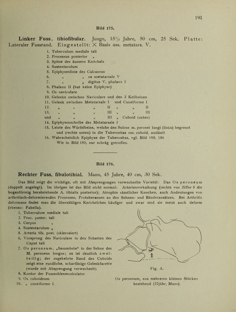 Bild 175. Linker Fuss, tibiofibular. Junge, 15x/2 Jahre, 50 cm, 25 Sek. Platte: Lateraler Fussrand. Eingestellt: X Basis oss. metatars. V. 1. Tuberculum mediale tali 2. Processus posterior „ 3. Spitze des äussern Knöchels 4. Sustentaculum 5. Epiphysenlinie des Calcaneus 6. „ „ os metatarsale V 7. „ digitus V, phalanx I 8. Phalanx II (hat keine Epiphyse) 9. Os naviculare 10. Gelenke zwischen Naviculare und den 3 Keilbeinen 11. Gelenk zwischen Metatarsale I und Cuneiforme I 12. , * » II n »II 13. „ „ „ III „ 71 III und „ „ „ III „ Cuboid (unten) 14. Epiphysenscheibe des Metatarsale I 15. Leiste des Würfelbeins, welche den Sulcus m. peronei longi (links) begrenzt und (rechts unten) in die Tuberositas oss. cuboid. ausläuft 16. Wahrscheinlich Epiphyse der Tuberositas, vgl. Bild 180, 186 Wie in Bild 180, nur schräg getroffen. Bild 176. Rechter Fuss, fibulotibial. Mann, 45 Jahre, 40 cm, 30 Sek. Das Bild zeigt die wichtige, oft mit Absprengungen verwechselte Varietät: Das Os peroneum (doppelt angelegt). Im übrigen ist das Bild nicht normal: Arterienverkalkung (rechts von Ziffer 5 die bogenförmig herabziehende A. tibialis posterior); Atrophie sämtlicher Knochen, auch Andeutungen von arthritisch-deformierenden Prozessen, Protuberanzen an den Sehnen- und Bänderansätzen. Bei Arthritis deformans findet man die überzähligen Knöchelchen häufiger und zwar sind sie meist auch deform (ebenso: Fabella). 1. Tuberculum mediale tali 2. Proc. poster. tali 3. Corpus „ 4. Sustentaculum „ 5. Arteria tib. post, (sklerosiert) 6. Vorsprung des Naviculare in den Schatten des Caput tali 7- Os peroneum, „Sesambein“ in der Sehne des M. peroneus longus; es ist deutlich zwei- teilig; der zugekehrte Rand des Cuboids zeigt eine rundliche, scharflinige Gelenkfacette (wurde mit Absprengung verwechselt). 8. Kontur der Fusssohlenmuskulatur 9. Os cuboideum 10. „ cuneiforme I. Os peroneum, aus mehreren kleinen Stücken bestehend (32jähr. Mann).