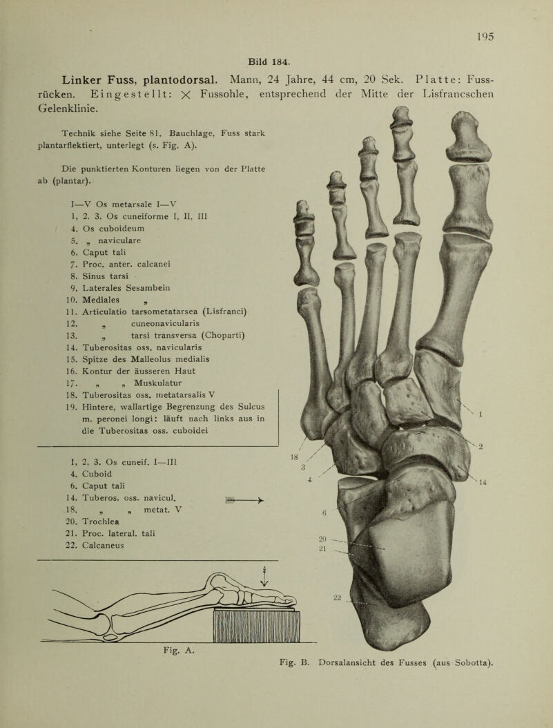 Bild 184. Linker Fuss, plantodorsal. Mann, 24 Jahre, 44 cm, 20 Sek. Platte: Fuss- riicken. Eingestellt: X Fussohle, entsprechend der Mitte der Lisfrancschen Gelenklinie. Technik siehe Seite 81. Bauchlage, Fuss stark plantarflektiert, unterlegt (s. Fig. A). Die punktierten Konturen liegen von der Platte ab (plantar). I—V Os metarsale I—V 1, 2. 3. Os cuneiforme I, II, III 4. Os cuboideum 5. „ naviculare 6. Caput tali 7. Proc. anter. calcanei 8. Sinus tarsi 9. Laterales Sesambein 10. Mediales „ 11. Articulatio tarsometatarsea (Lisfranci) 12. „ cuneonavicularis 13. „ tarsi transversa (Choparti) 14. Tuberositas oss. navicularis 15. Spitze des Malleolus medialis 16. Kontur der äusseren Haut 1/. „ „ Muskulatur 18. Tuberositas oss. metatarsalis V 19. Hintere, wallartige Begrenzung des Sulcus m. peronei longi: läuft nach links aus in die Tuberositas oss. cuboidei 1, 2, 3. Os cuneif. I—III 4. Cuboid 6. Caput tali 14. Tuberos. oss. navicul. 18. „ „ metat. V 20. Trochlea 21. Proc. lateral, tali 22. Calcaneus Fig. A. Fig. B. Dorsalansicht des Fusses (aus Sobotta).