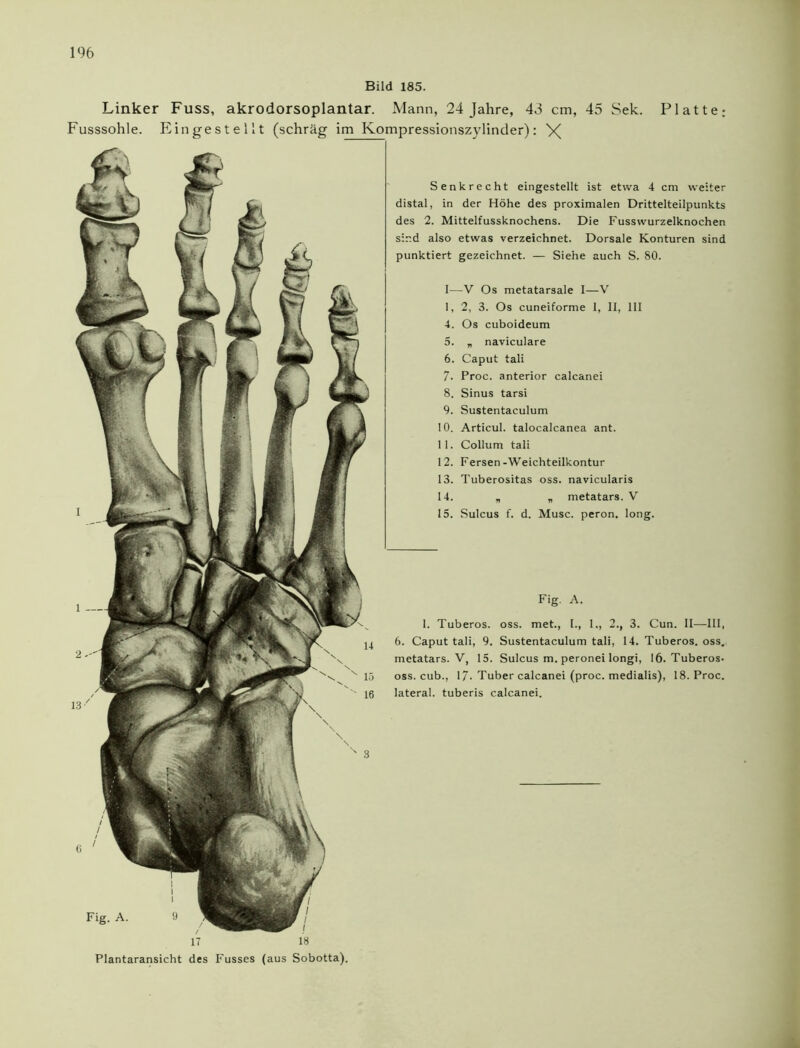 Bild 185. 17 18 Plantaransicht des Fusses (aus Sobotta). Linker Fuss, akrodorsoplantar. Mann, 24 Jahre, 43 cm, 45 Sek. Platte: Fusssohle. Eingestellt (schräg im Kompressionszylinder): X Senkrecht eingestellt ist etwa 4 cm weiter distal, in der Höhe des proximalen Drittelteilpunkts des 2. Mittelfussknochens. Die Fusswurzelknochen sind also etwas verzeichnet. Dorsale Konturen sind punktiert gezeichnet. — Siehe auch S. 80. I—V Os metatarsale I—V 1, 2, 3. Os cuneiforme 1, II, 111 4. Os cuboideum 5. „ naviculare 6. Caput tali 7. Proc. anterior calcanei 8. Sinus tarsi 9. Sustentaculum 10. Articul. talocalcanea ant. 11. Collum tali 12. Fersen-Weichteilkontur 13. Tuberositas oss. navicularis 14. * „ metatars. V 15. Sulcus f. d. Muse, peron. long. Fig. A. 1. Tuberos. oss. met., I., 1., 2., 3. Cun. II—III, 6. Caput tali, 9. Sustentaculum tali, 14. Tuberos. oss. metatars. V, 15. Sulcus m. peronei longi, 16. Tuberos. oss. cub., 17. Tuber calcanei (proc. medialis), 18. Proc. lateral, tuberis calcanei.