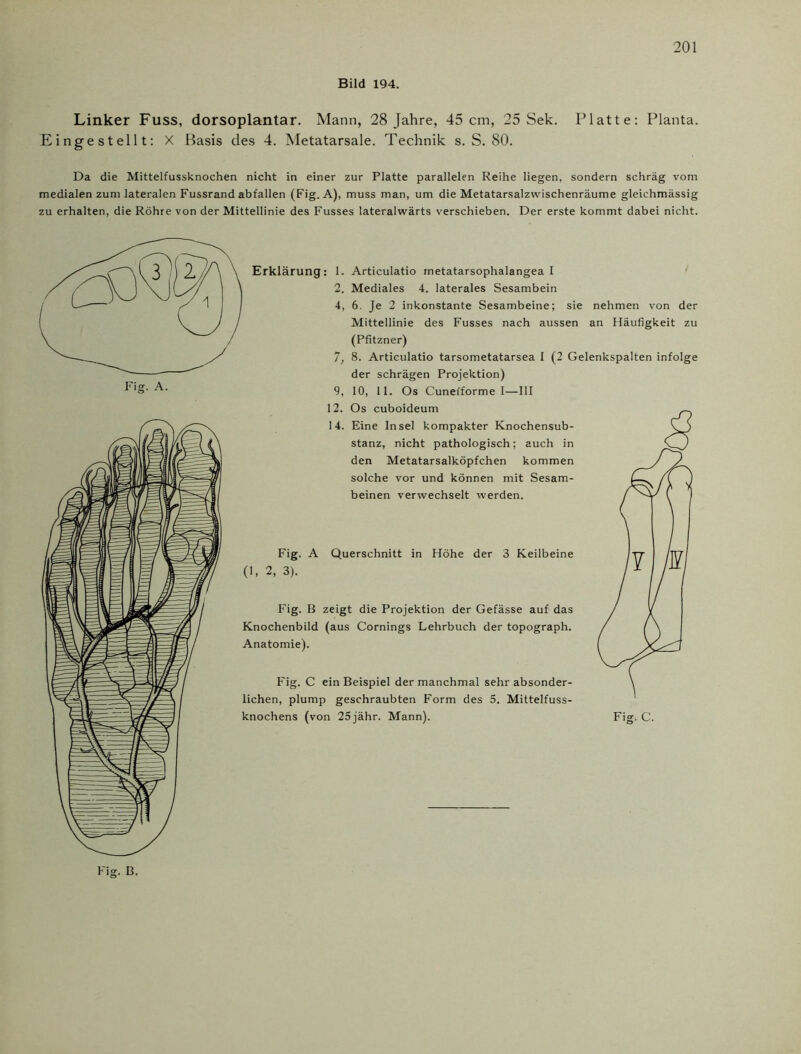 Bild 194. Linker Fuss, dorsoplantar. Mann, 28 Jahre, 45 cm, 25 Sek. Eingestellt: X Basis des 4. Metatarsale. Technik s. S. 80. Platte: Planta. Da die Mittelfussknochen nicht in einer zur Platte parallelen Reihe liegen, sondern schräg vom medialen zum lateralen Fussrand abfallen (Fig. A), muss man, um die Metatarsalzvvischenräume gleiehmässig zu erhalten, die Röhre von der Mittellinie des Fusses lateralwärts verschieben. Der erste kommt dabei nicht. Erklärung: 1. Articulatio metatarsophalangea I 2. Mediales 4. laterales Sesambein 4, 6. Je 2 inkonstante Sesambeine; sie nehmen von der Mittellinie des Fusses nach aussen an Häufigkeit zu (Pfitzner) 7, 8. Articulatio tarsometatarsea I (2 Gelenkspalten infolge der schrägen Projektion) 9, 10, 11. Os Cunefforme I—III 12. Os cuboideum 14. Eine Insel kompakter Knochensub- stanz, nicht pathologisch; auch in den Metatarsalköpfchen kommen solche vor und können mit Sesam- beinen verwechselt werden. Fig. A Querschnitt in Höhe der 3 Keilbeine (1, 2, 3). Fig. B zeigt die Projektion der Gefässe auf das Knochenbild (aus Cornings Lehrbuch der topograph. Anatomie). Fig. C ein Beispiel der manchmal sehr absonder- lichen, plump geschraubten Form des 5. Mittelfuss- knochens (von 25jähr. Mann).