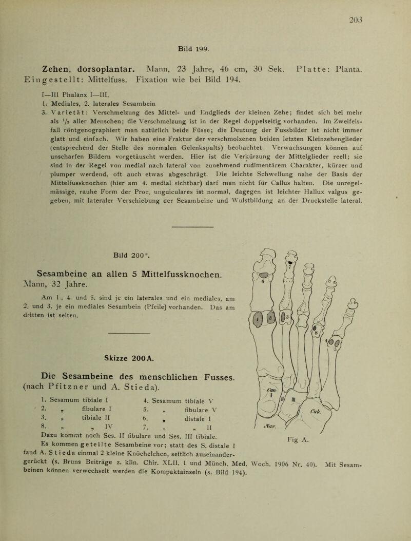 Bild 199. Zehen, dorsoplantar. Mann, 23 Jahre, 46 cm, 30 Sek. Platte: Planta. Eingestellt: Mittelfuss. Fixation wie bei Bild 194. I—111 Phalanx I—III. 1. Mediales, 2. laterales Sesambein 3. Varietät: Verschmelzung des Mittel- und Endglieds der kleinen Zehe; findet sich bei mehr als ’/s aller Menschen; die Verschmelzung ist in der Regel doppelseitig vorhanden. Im Zweifels- fall röntgenographiert man natürlich beide Füsse; die Deutung der Fussbilder ist nicht immer glatt und einfach. Wir haben eine Fraktur der verschmolzenen beiden letzten Kleinzehenglieder (entsprechend der Stelle des normalen Gelenkspalts) beobachtet. Verwachsungen können auf unscharfen Bildern vorgetäuscht werden. Hier ist die Verkürzung der Mittelglieder reell; sie sind in der Regel von medial nach lateral von zunehmend rudimentärem Charakter, kürzer und plumper werdend, oft auch etwas abgeschrägt. Die leichte Schwellung nahe der Basis der Mittelfussknochen (hier am 4. medial sichtbar) darf man nicht für Callus halten. Die unregel- mässige, rauhe Form der Proc. unguiculares ist normal, dagegen ist leichter Hallux valgus ge- geben, mit lateraler Verschiebung der Sesambeine und Wulstbildung an de- Druckstelle lateral. Bild 200*. Sesambeine an allen 5 Mittelfussknochen. Mann, 32 Jahre. Am 1., 4. und 5. sind je ein laterales und ein mediales, am 2. und 3. je ein mediales Sesambein (Pfeile) vorhanden. Das am dritten ist selten. Skizze 200A. Die Sesambeine des menschlichen Fusses. (nach Pfitzner und A. Stieda). 1. Sesamum tibiale I 4. Sesamum tibiale V 2. „ fibulare I 5. „ fibulare V 3. n tibiale II 6. „ distale 1 8- - . IV 7. „ „II Dazu kommt noch Ses. 11 fibulare und Ses. III tibiale. Es kommen geteilte Sesambeine vor; statt des S. distale 1 fand A. Stieda einmal 2 kleine Knöchelchen, seitlich auseinander- gerückt (s. Bruns Beiträge z. klin. Chir. XLII. 1 und Münch. Med. Woch. 1906 Nr. 40). Mit Sesam- beinen können verwechselt werden die Kompaktainseln (s. Bild 194).