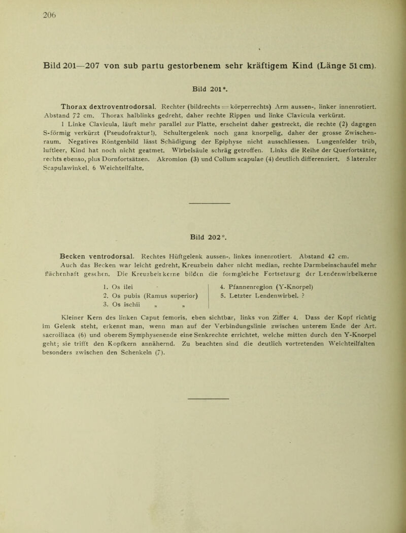 Bild 201—207 von sub partu gestorbenem sehr kräftigem Kind (Lange 51cm). Thorax dextroventrodorsal. Rechter (bildrechts = körperrechts) Arm aussen-, linkerinnenrotiert. Abstand 72 cm. Thorax halblinks gedreht, daher rechte Rippen und linke Clavicula verkürzt. 1 Linke Clavicula, läuft mehr parallel zur Platte, erscheint daher gestreckt, die rechte (2) dagegen S-förmig verkürzt (Pseudofraktur!). Schultergelenk noch ganz knorpelig, daher der grosse Zwischen- raum. Negatives Röntgenbild lässt Schädigung der Epiphyse nicht ausschliessen. Lungenfelder trüb, luftleer, Kind hat noch nicht geatmet. Wirbelsäule schräg getroffen. Links die Reihe der Querfortsätze, rechts ebenso, plus Dornfortsätzen. Akromion (3) und Collum scapulae (4) deutlich differenziert. 5 lateraler Scapulawinkel, 6 Weichteilfalte. Becken ventrodorsal. Rechtes Hüftgelenk aussen-, linkes innenrotiert. Abstand 42 cm. Auch das Becken war leicht gedreht, Kreuzbein daher nicht median, rechte Darmbeinschaufel mehr flächenhaft gesehen. Die Kreuzbeir kerne bilden die foemgleiche Fortsetzurg der Lendenwirbelkerne Kleiner Kern des linken Caput femoris, eben sichtbar, links von Ziffer 4. Dass der Kopf richtig im Gelenk steht, erkennt man, wenn man auf der Verbindungslinie zwischen unterem Ende der Art. sacroiliaca (6) und oberem Symphysenende eine Senkrechte errichtet, welche mitten durch den Y-Knorpel geht; sie trifft den Kopfkern annähernd. Zu beachten sind die deutlich vortretenden Weichteilfalten besonders zwischen den Schenkeln (7). Bild 201*. Bild 202*. 1. Os ilei 2. Os pubis (Ramus superior) 3. Os ischii „ „ 4. Pfannenregion (Y-Knorpel) 5. Letzter Lendenwirbel. ?
