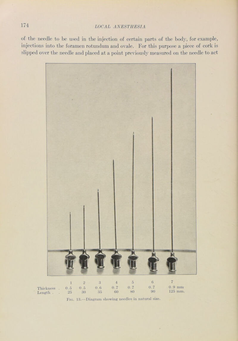 of the needle to be used in the injection of certain parts of the body, for example, injections into the foramen rotundum and ovale. For this purpose a piece of cork is slipped over the needle and placed at a point previously measured on the needle to act Thickness Length . ] 2 3 4 5 6 7 0.5 0.5 0.G 0.7 0.7 0.7 0.9 mm 25 30 35 60 80 90 125 mm. Fig. 13.—Diagram showing needles in natural size.