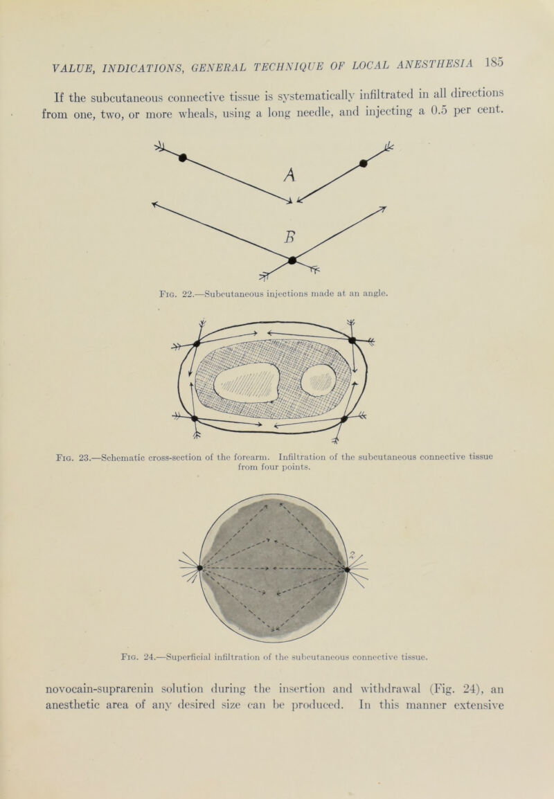 If the subcutaneous connective tissue is Systematically infiltrated in all directions from one, two, or more wheals, using a long needle, and injecting a 0.5 per eent. Fig. 22.—Subcutaneous injections made at. an angle. Fig. 23.—Schematic cross-section of the forearm. Infiltration of the subcutaneous connective tissue from four points. Fig. 24.—Superficial infiltration of the subcutaneous connective tissue. novocain-suprarenin solution during the insertion and withdrawal (Fig. 24), an anesthetic area of any desired size can be produced. In this manner extensive