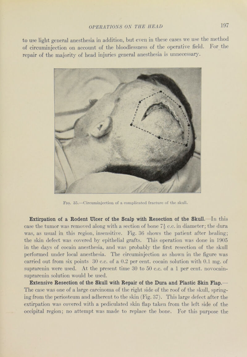 to use light general anesthesia in addition, but even in these cases we use the method of circuminjection on acconnt of the bloodlessness of the operative field. hör the repair of the majoritv of head injnries general anesthesia is unnecessary. Fig. 35.—Circuminjection of a complicated fracture of the skull. Extirpation of a Rodent Ulcer of the Scalp with Resection of the Skull.—In this case the tumor was removed along with a section of hone 7| c.c. in diameter; the dura was, as usual in this region, insensitive. Fig. 36 shows the patient after healing; the skin defect was covered by epithelial grafts. This Operation was done in 1905 in the days of cocain anesthesia, and was probably the first resection of the skull performed under local anesthesia. The circuminjection as shown in the figure was carried out from six points 30 c.c. of a 0.2 per cent. cocain Solution with 0.1 mg. of suprarenin were used. At the present time 30 to 50 c.c. of a 1 per cent. novocain- suprarenin solution would be used. Extensive Resection of the Skull with Repair of the Dura and Plastic Skin Flap. The case was one of a large carcinoma of the right side of the roof of the skull, spring- ing from the periosteum and adherent to the skin (Fig. 37). This large defect after the extirpation was covered with a pediculated skin flap taken from the left side of the occipital region; no attempt was made to replace the hone. For this purpose the