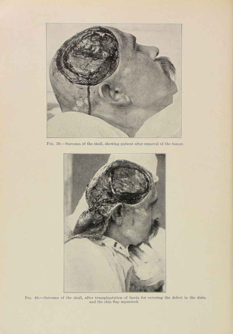 Fig. 40.—Sarcoma of the skull, after transplantation of fascia for covering the defect in the dura and the skin flap separated.